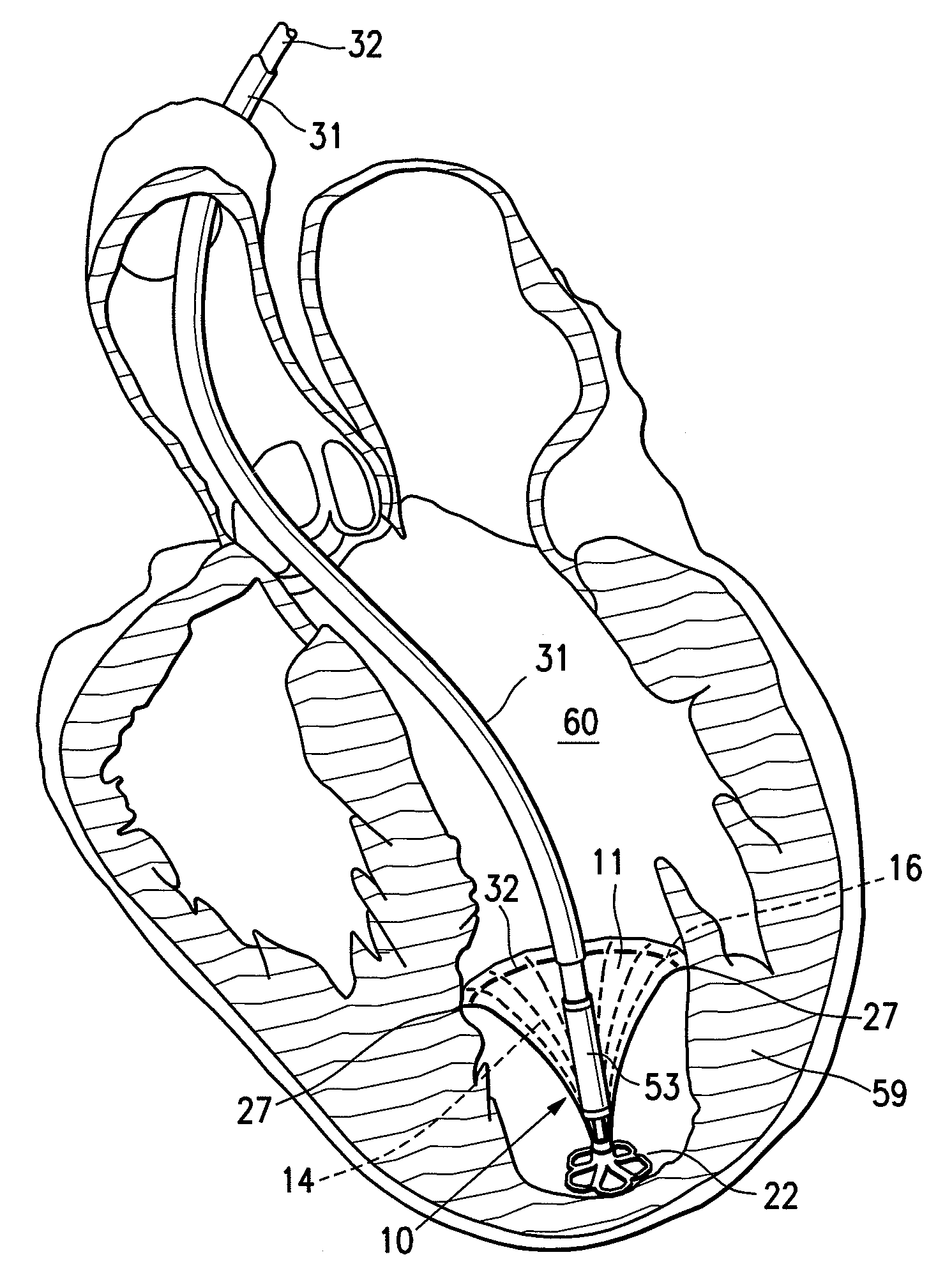 System for improving cardiac function by sealing a partitioning membrane within a ventricle
