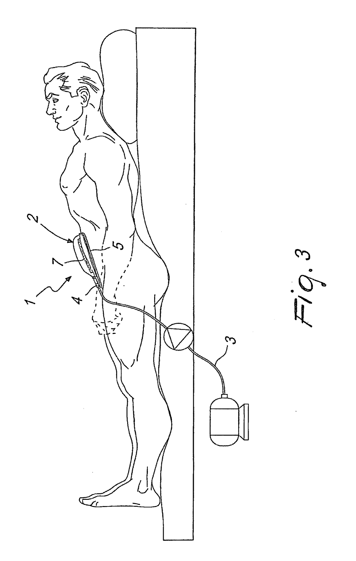 Drainage device particularly for aspiration in case of therapies with aspiration, fistulas, dehiscences of surgical wounds, bedsores, traumas and similar lesions