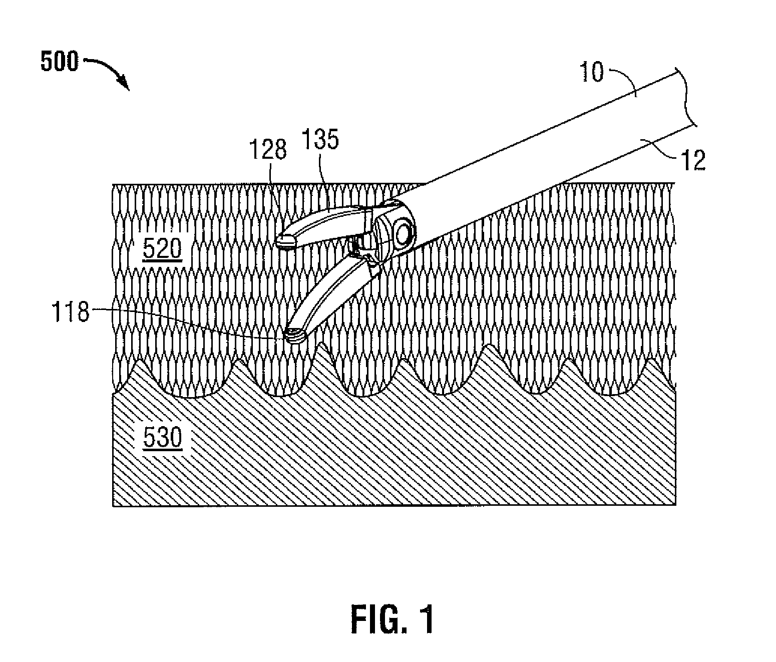 Bipolar chondroplasty device