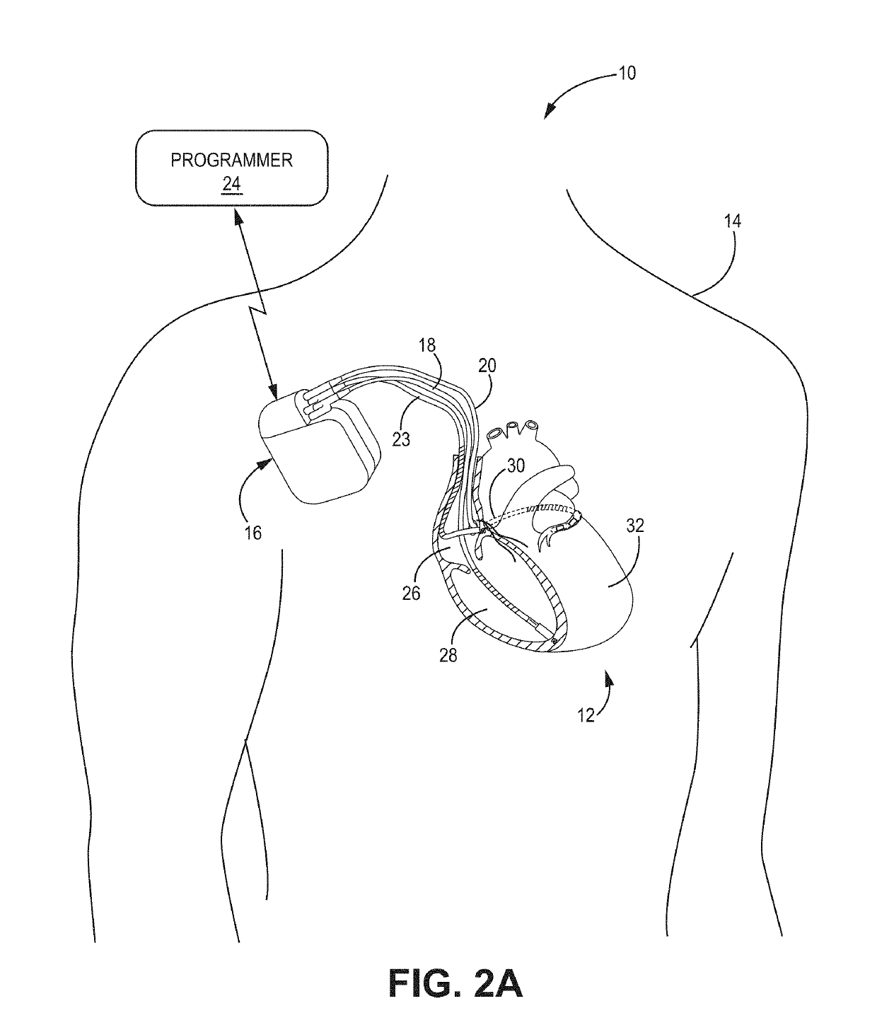Bundle branch pacing devices and methods