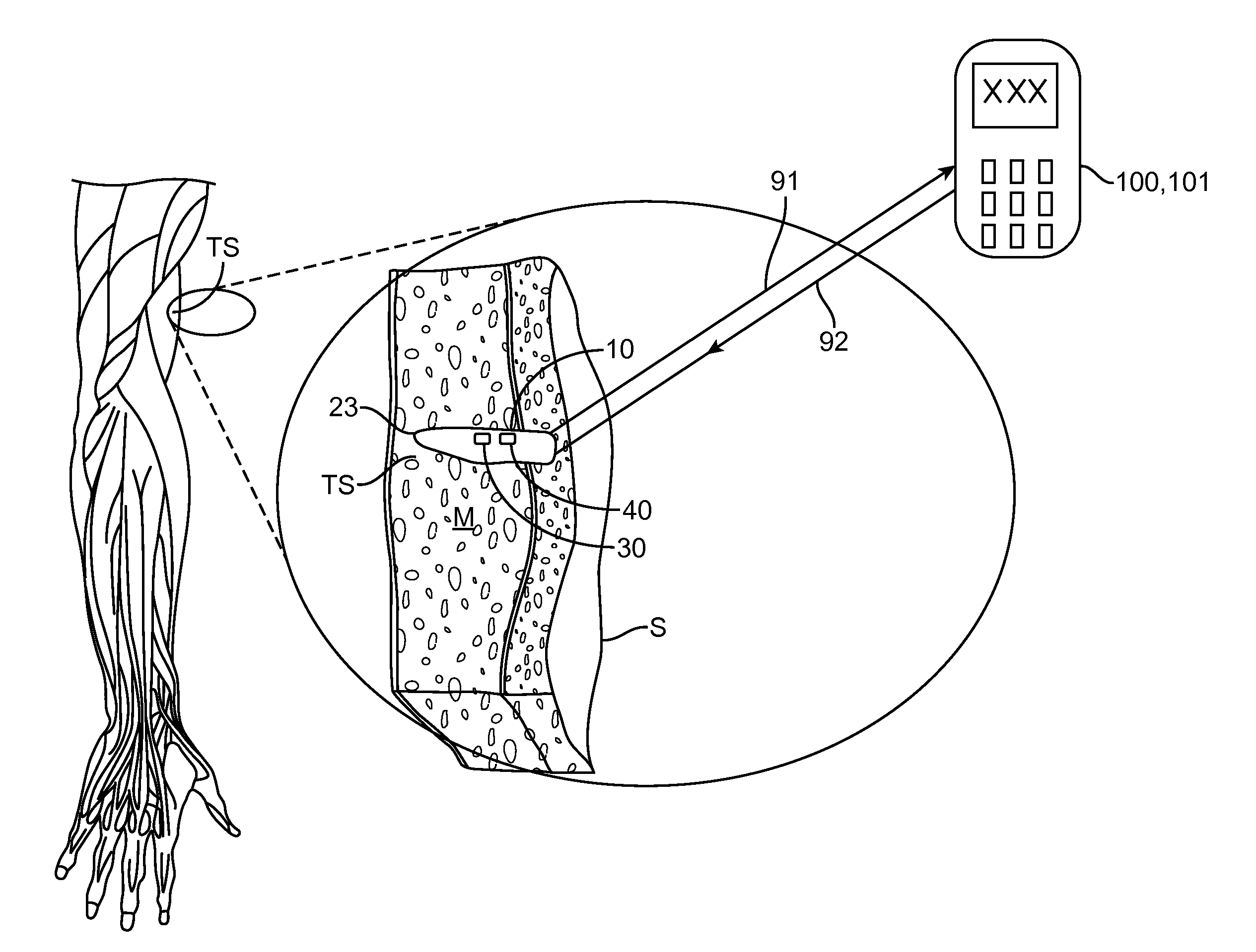 Implantable oximetric measurement apparatus and method of use
