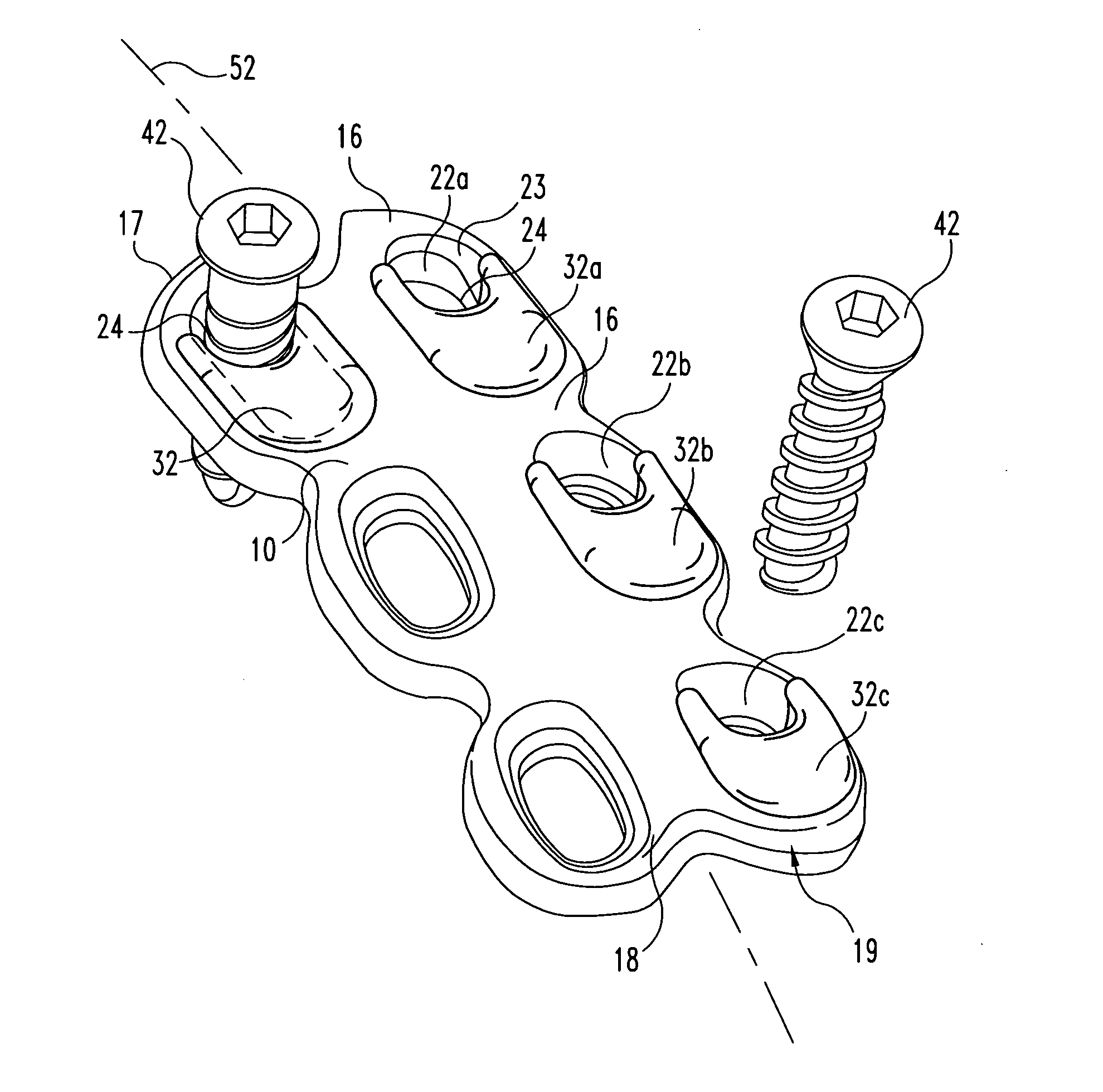 Apparatus and method for providing dynamizable translations to orthopedic implants