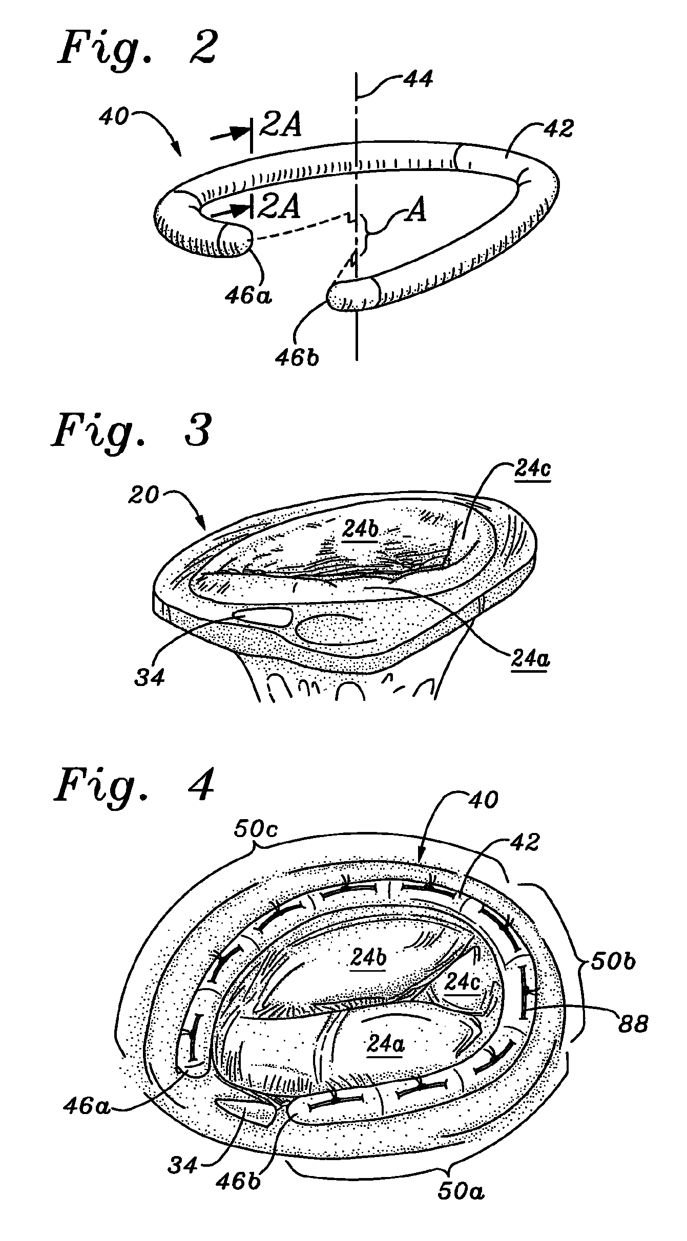 Three-dimensional annuloplasty ring and template