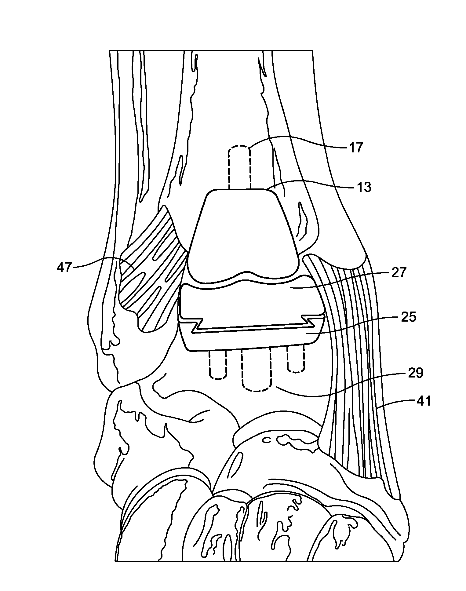 Stabilized total ankle prosthesis