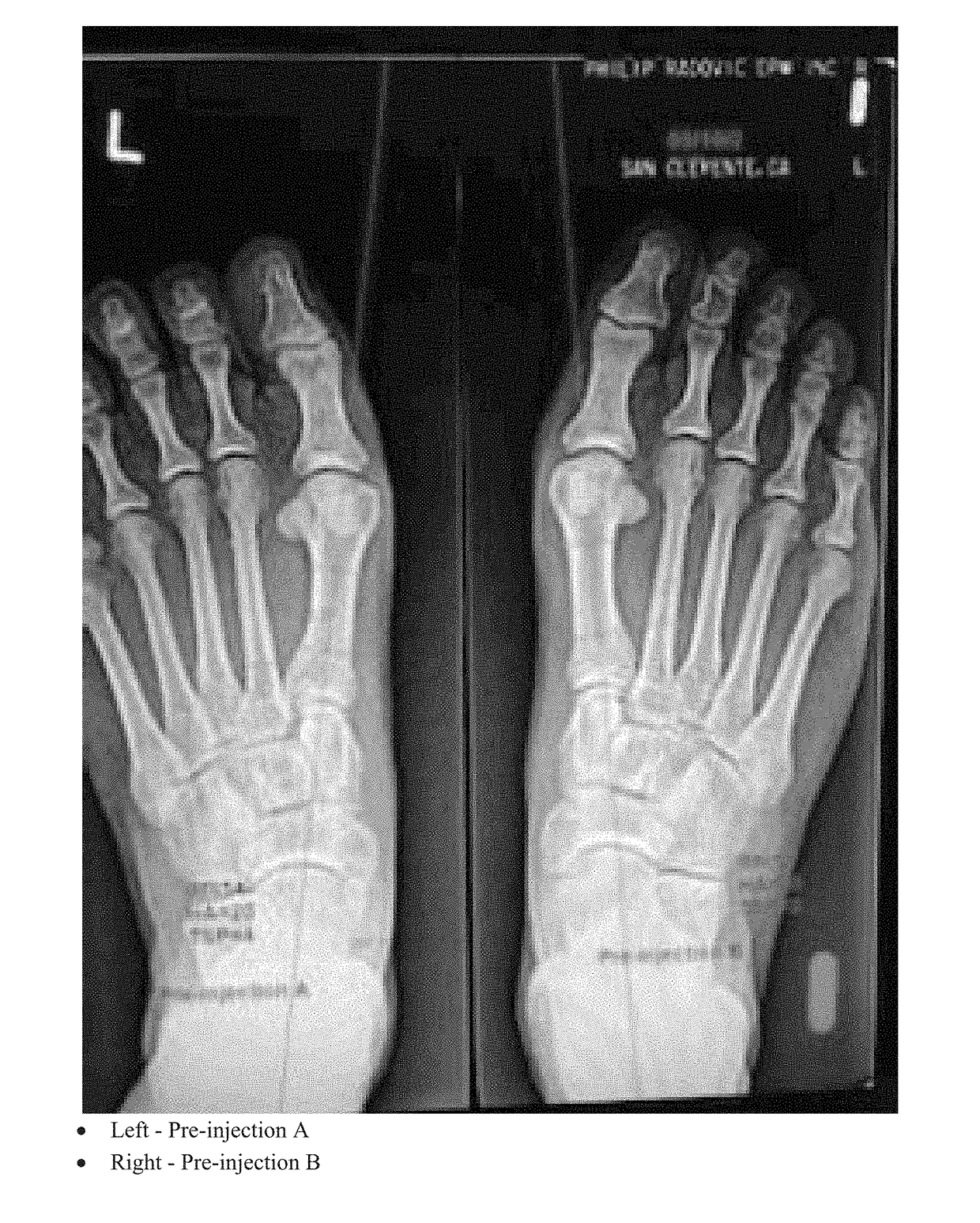 Methods of treating abnormalities of the first metatarsophalangeal joint of the foot