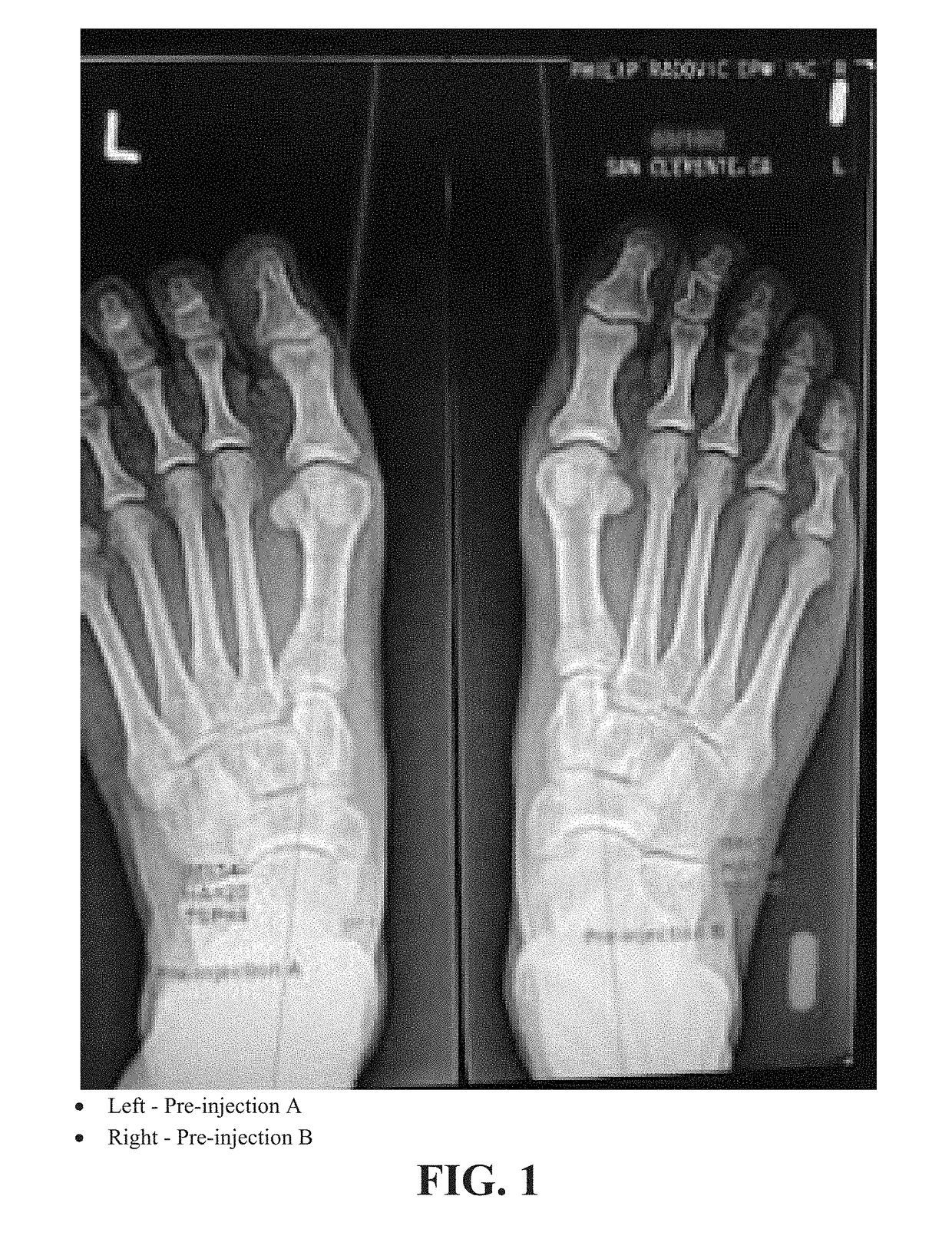 Methods of treating abnormalities of the first metatarsophalangeal joint of the foot