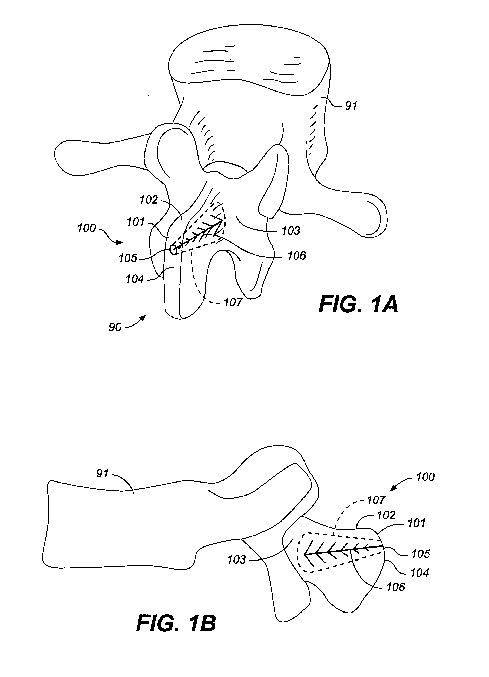 Device and method for correcting a spinal deformity