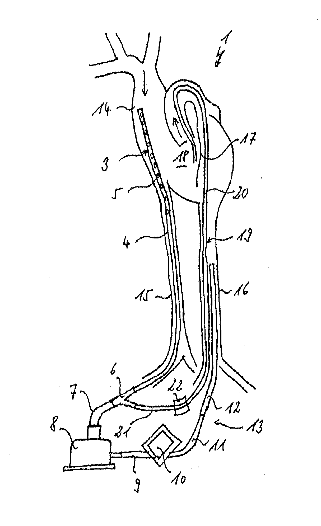 Assembly comprising a suction line, a pressure line and a pump