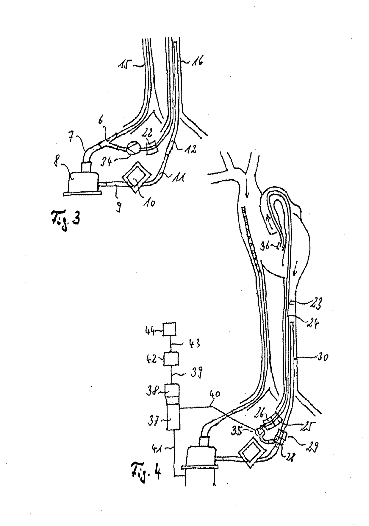 Assembly comprising a suction line, a pressure line and a pump