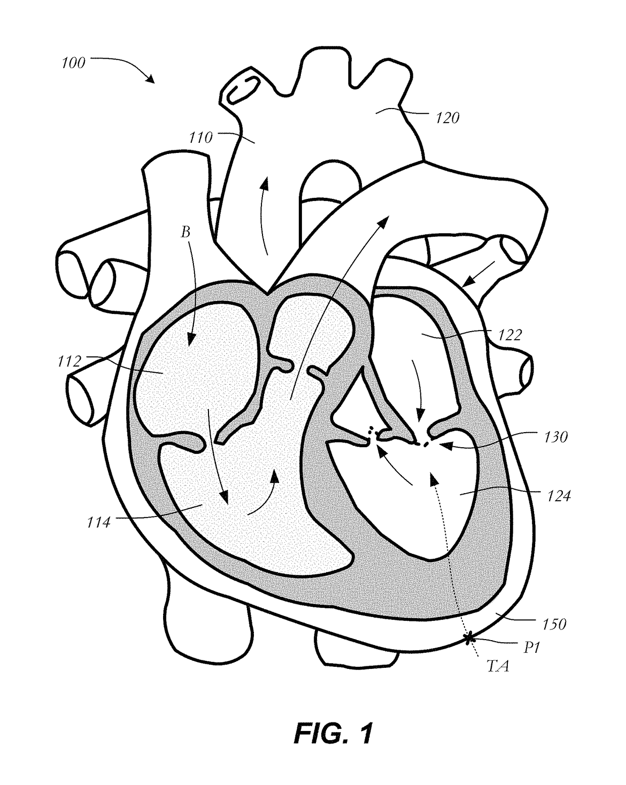 Mitral heart valve replacement