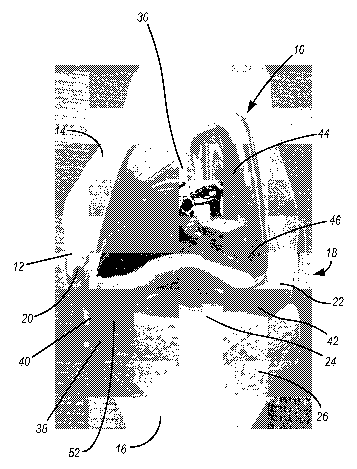Implants with Transition Surfaces and Related Processes
