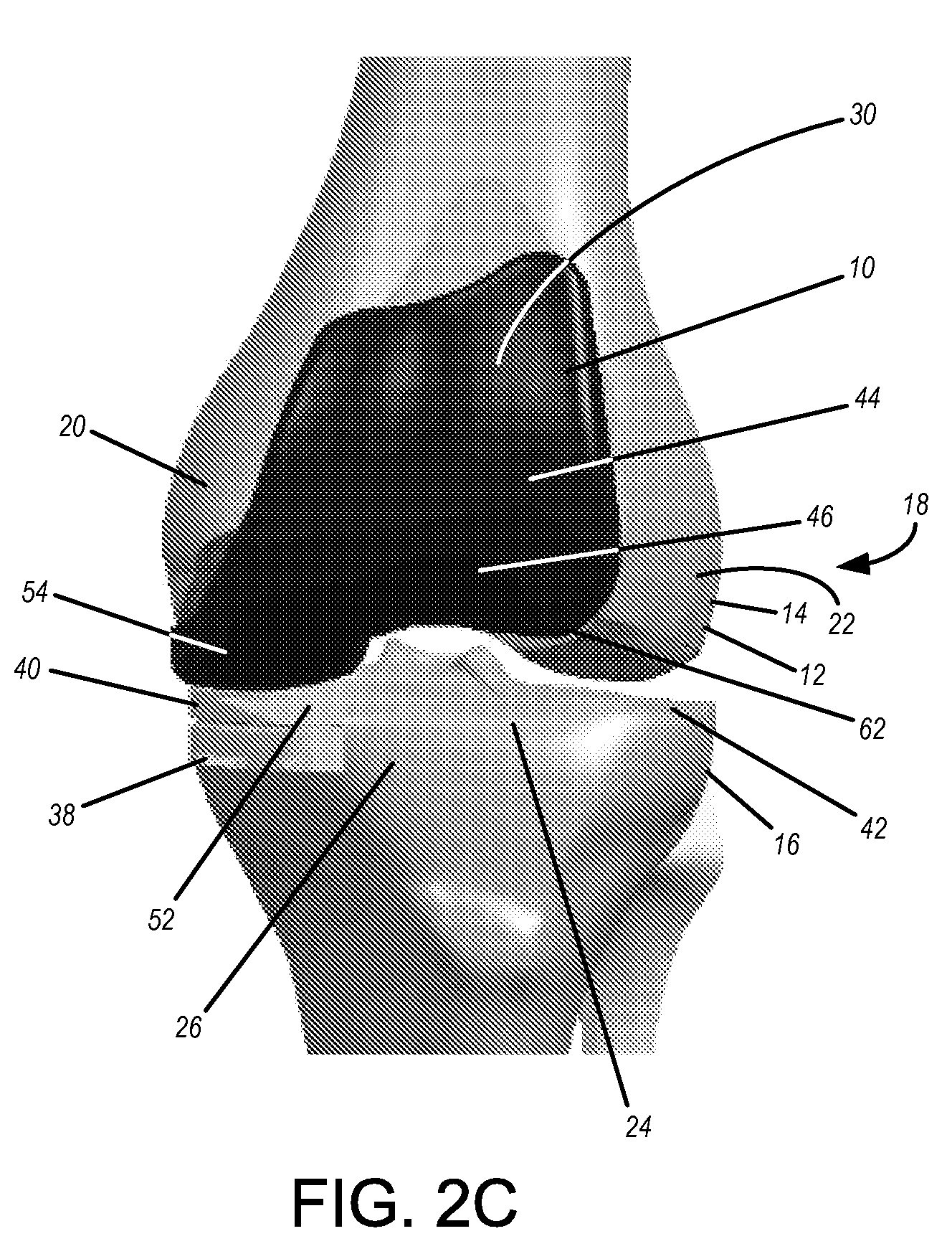 Implants with Transition Surfaces and Related Processes