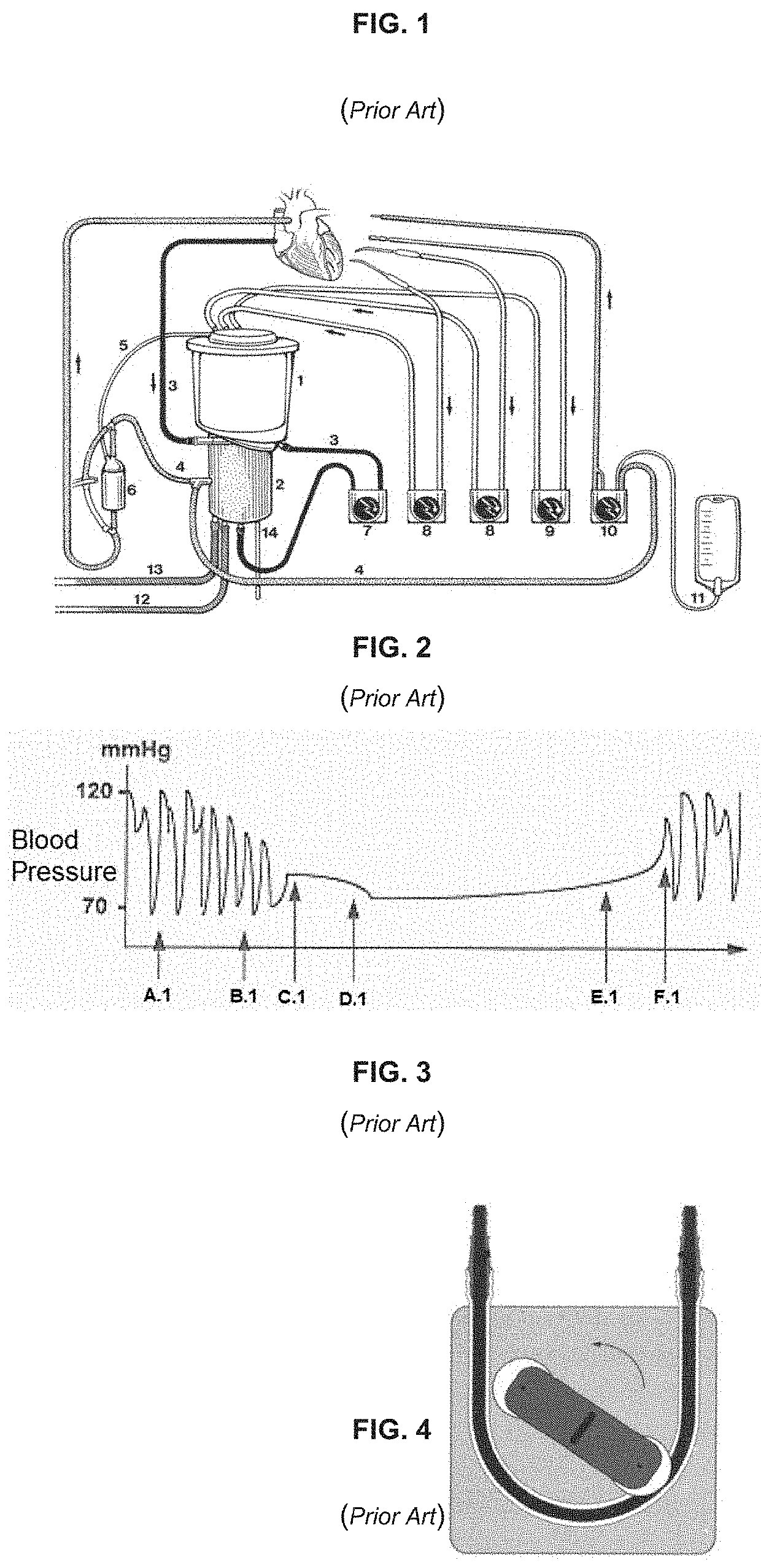 Pump for artificial circulatory assistance and a pumping system