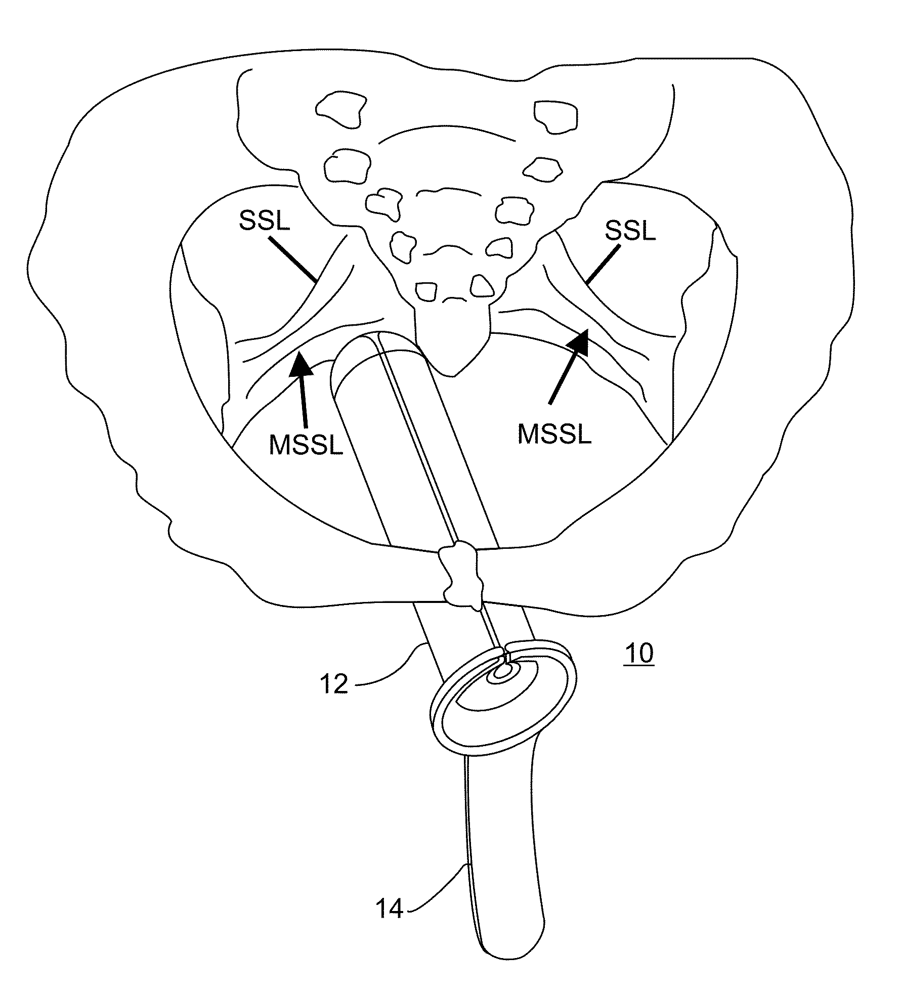System and method for pelvic floor repair