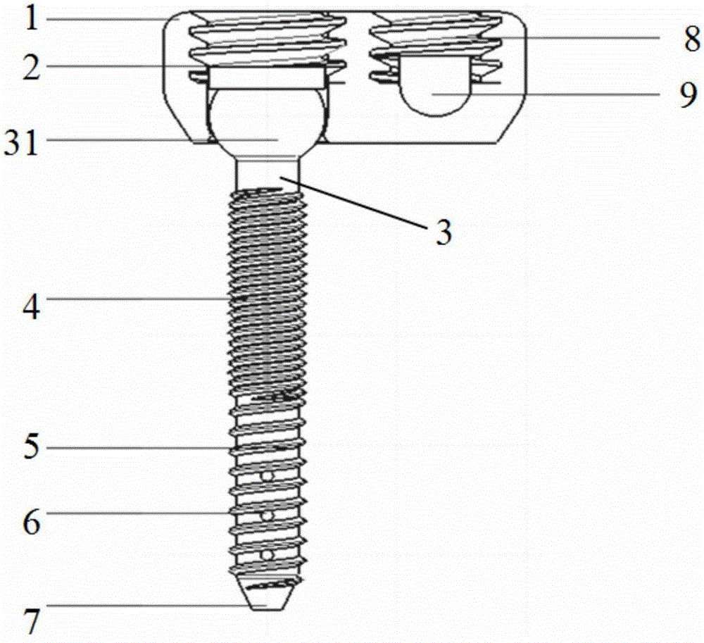 Low-profile bidirectional locking large-angle universal pedicle screw