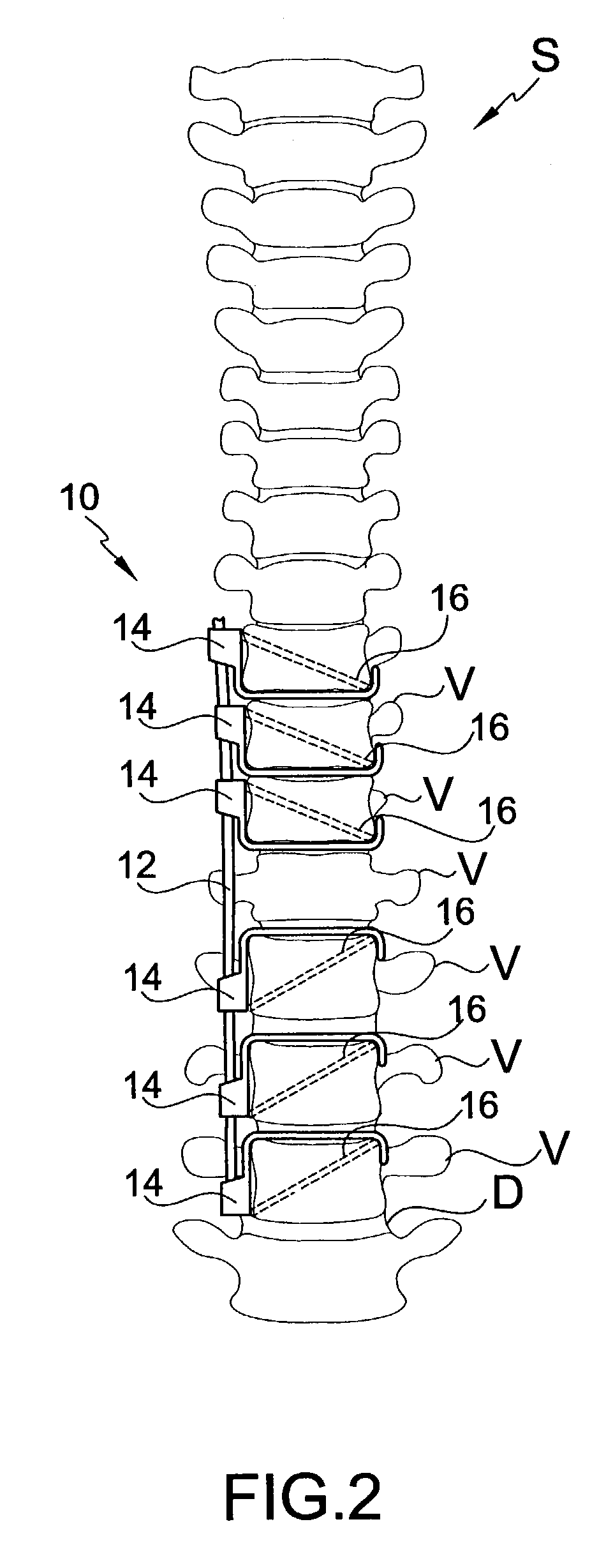 Connector for attaching an alignment rod to a bone structure