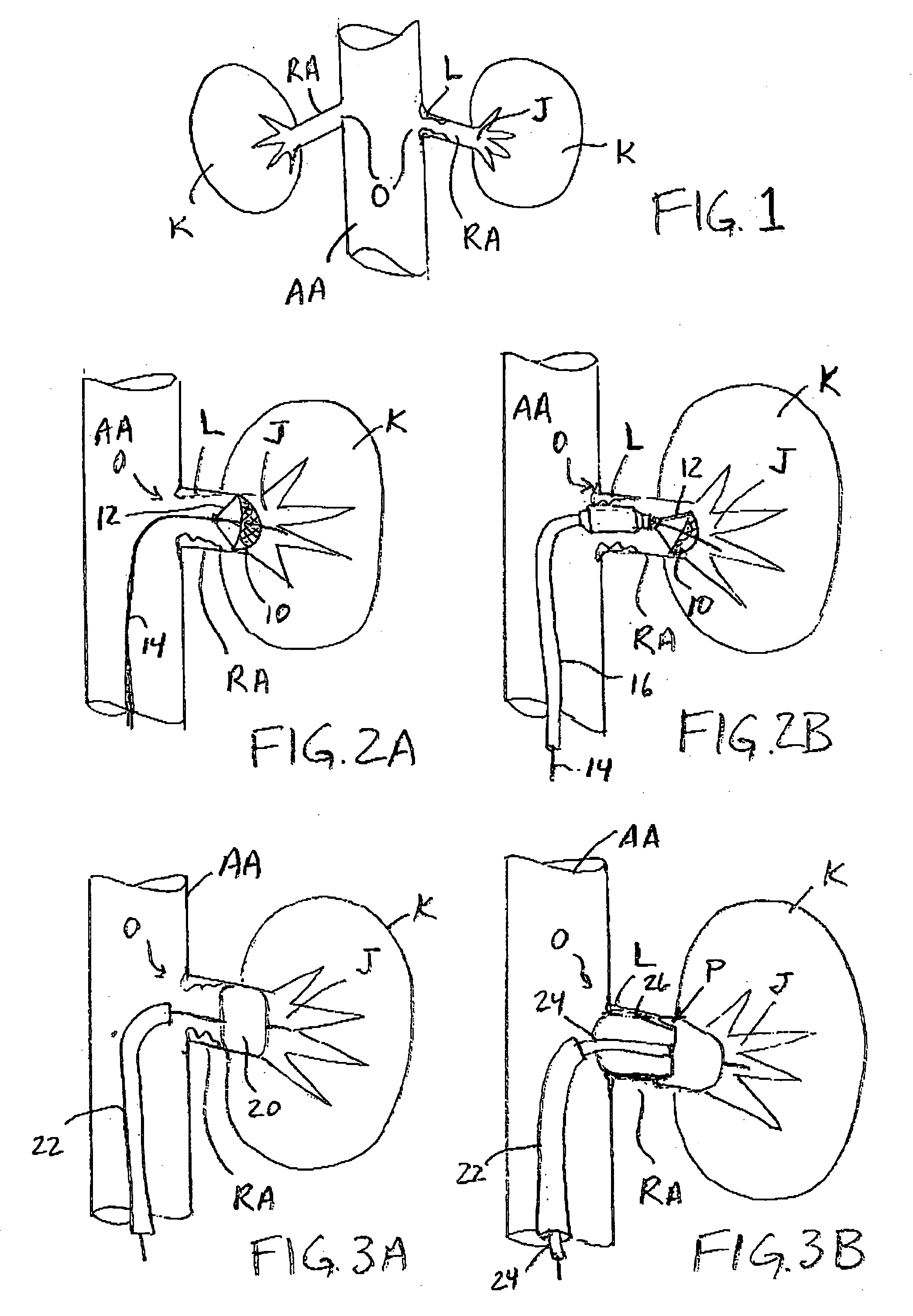 Apparatus and methods for renal stenting