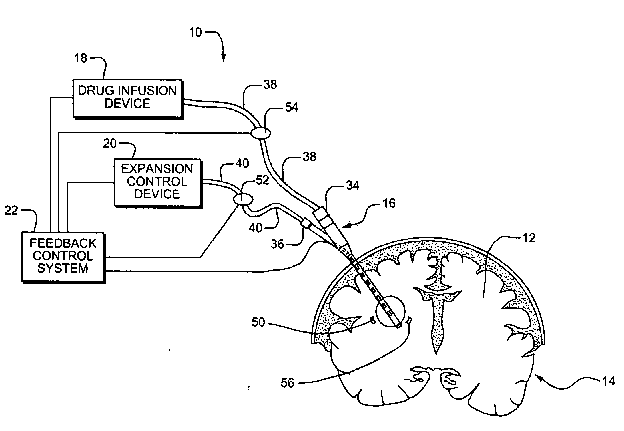 Systems and Methods for Drug Infusion with Feedback Control