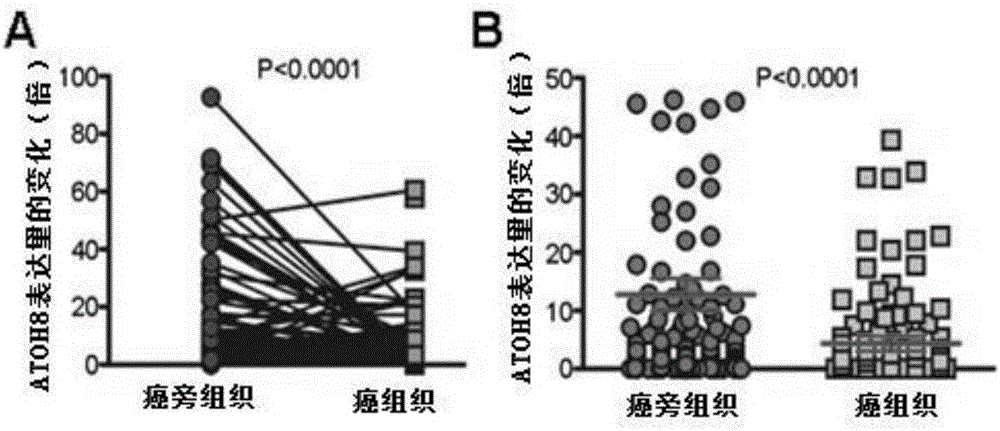 Application of tumor suppressor gene atoh8 and its encoded protein