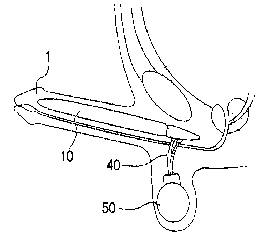 Inflatable Prosthesis For Aiding Penile Erection And Augmentation
