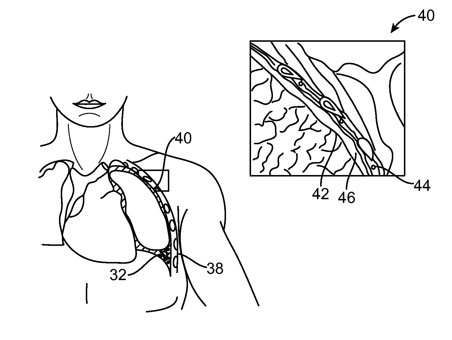 Lung Volume Reduction Devices, Methods, and Systems