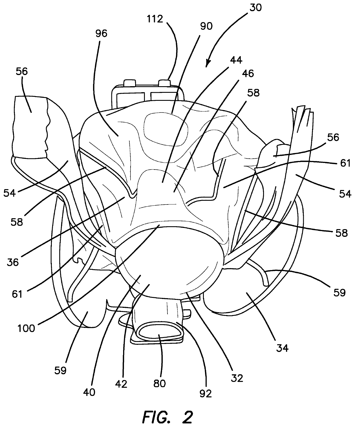 Hysterectomy model