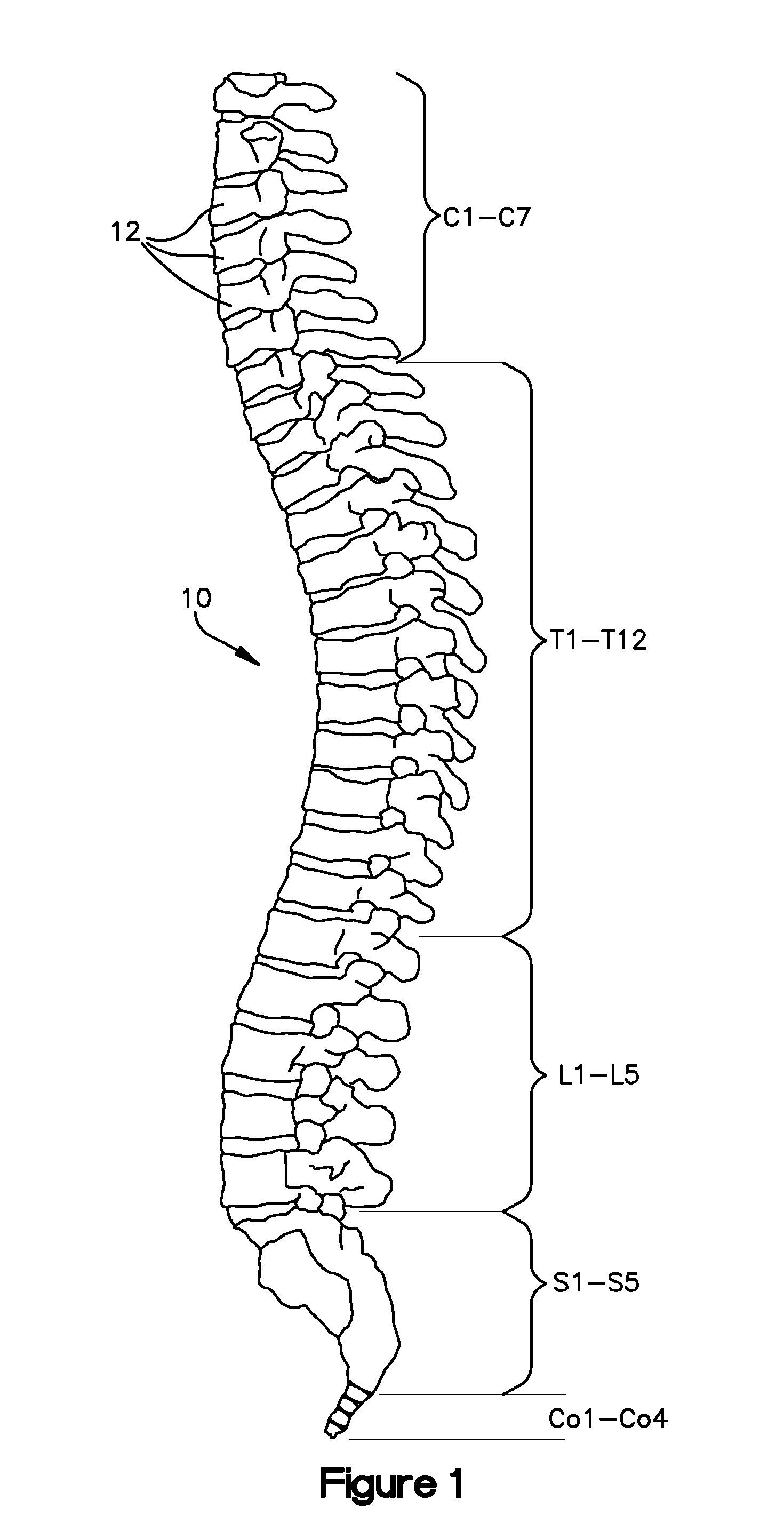 Method for resurfacing a cervical articular facet