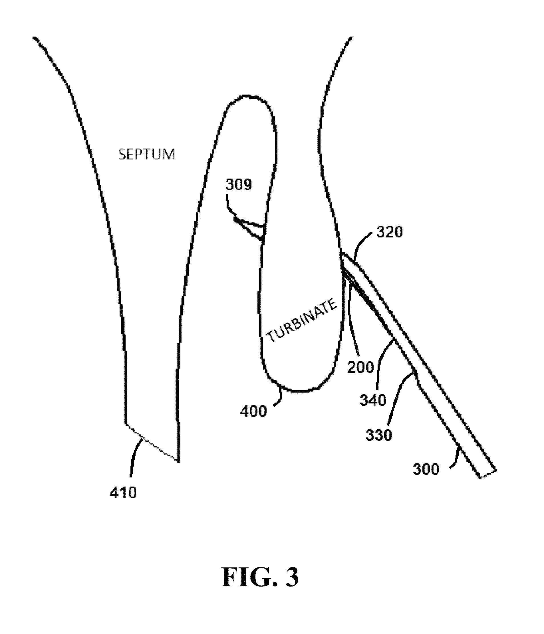 Methods and systems for medializing a turbinate