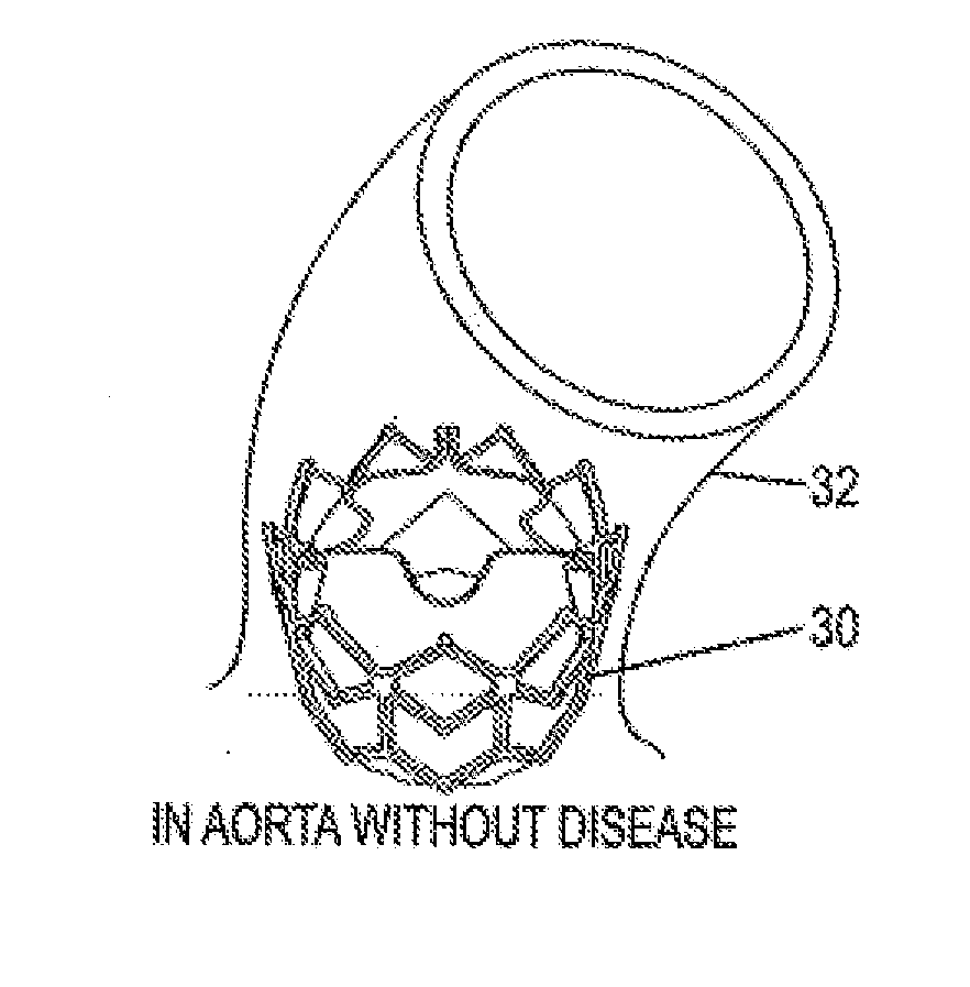 Methods for inhibiting stenosis, obstruction, or calcification of a stented heart valve or bioprosthesis