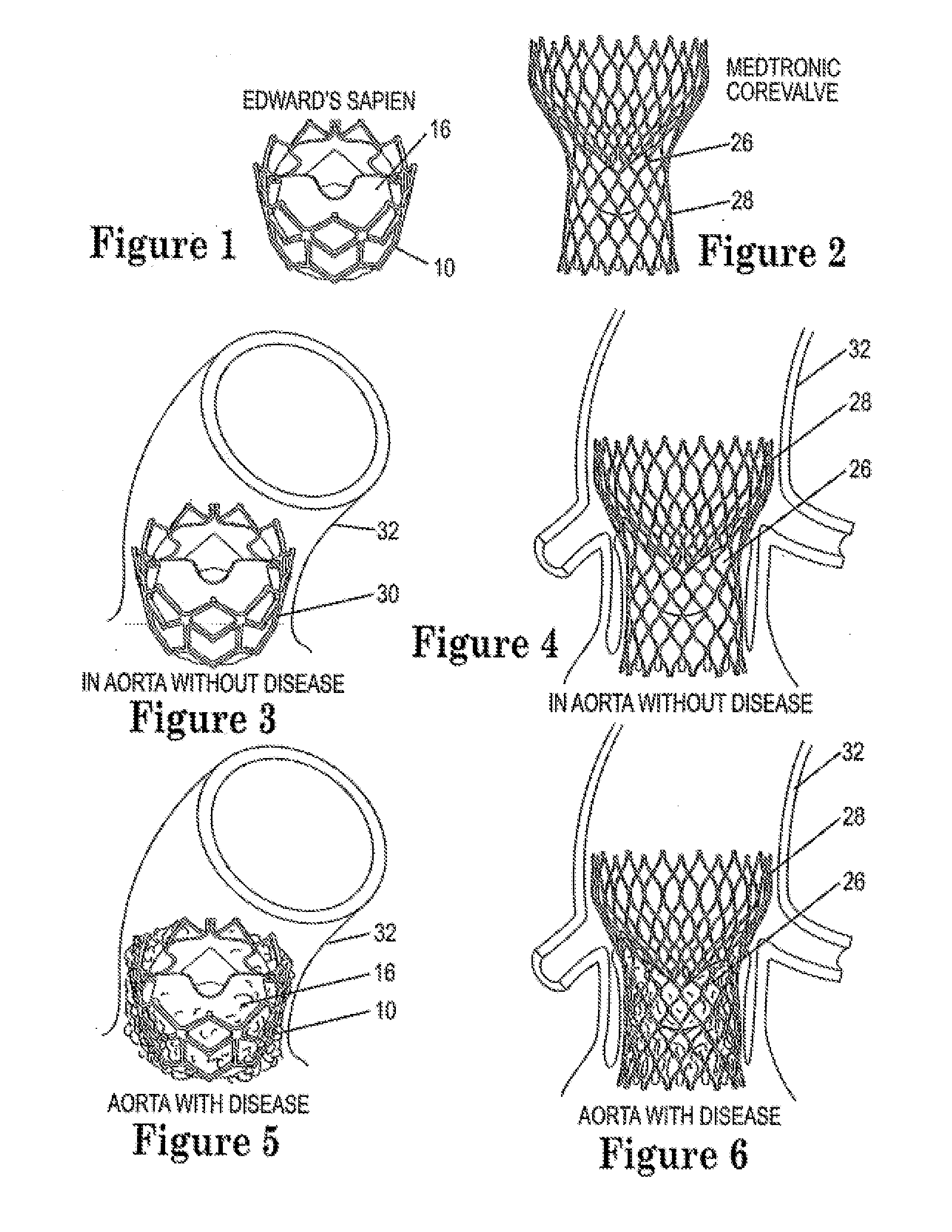 Methods for inhibiting stenosis, obstruction, or calcification of a stented heart valve or bioprosthesis