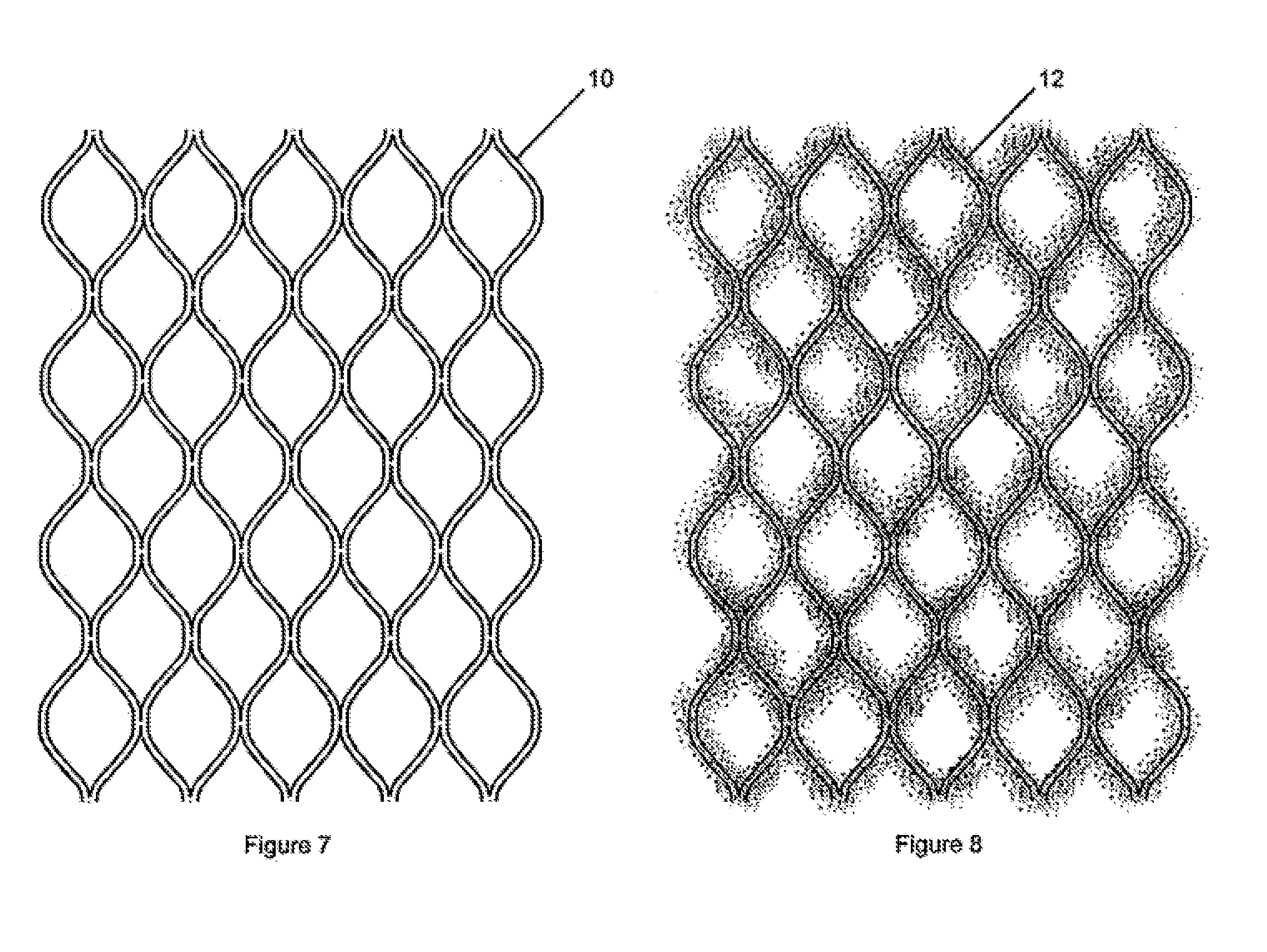 Methods for inhibiting stenosis, obstruction, or calcification of a stented heart valve or bioprosthesis