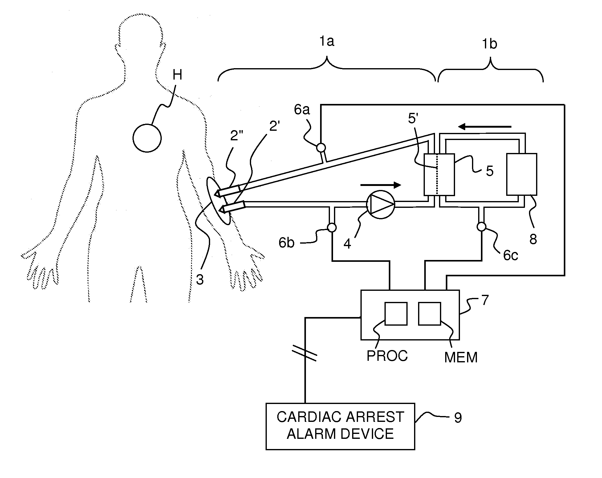 Monitoring of cardiac arrest in a patient connected to an extracorporeal blood processing apparatus