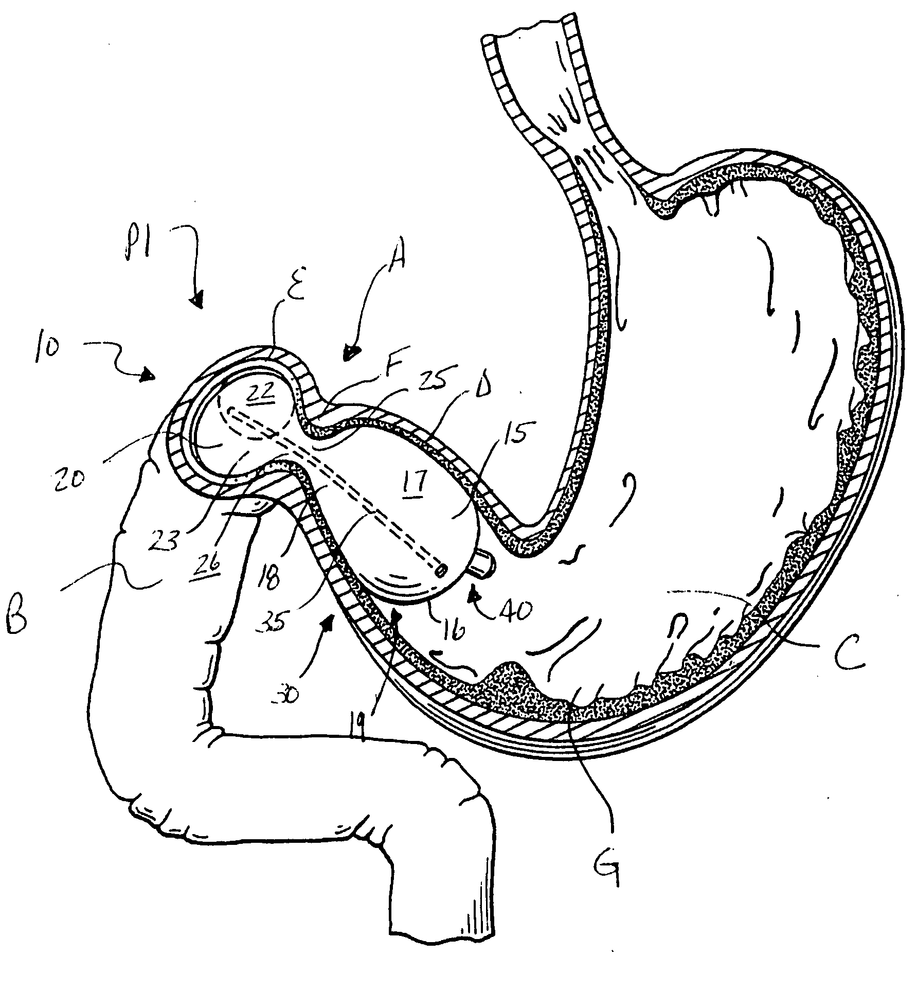 Method for treating obesity using an implantable weight loss device