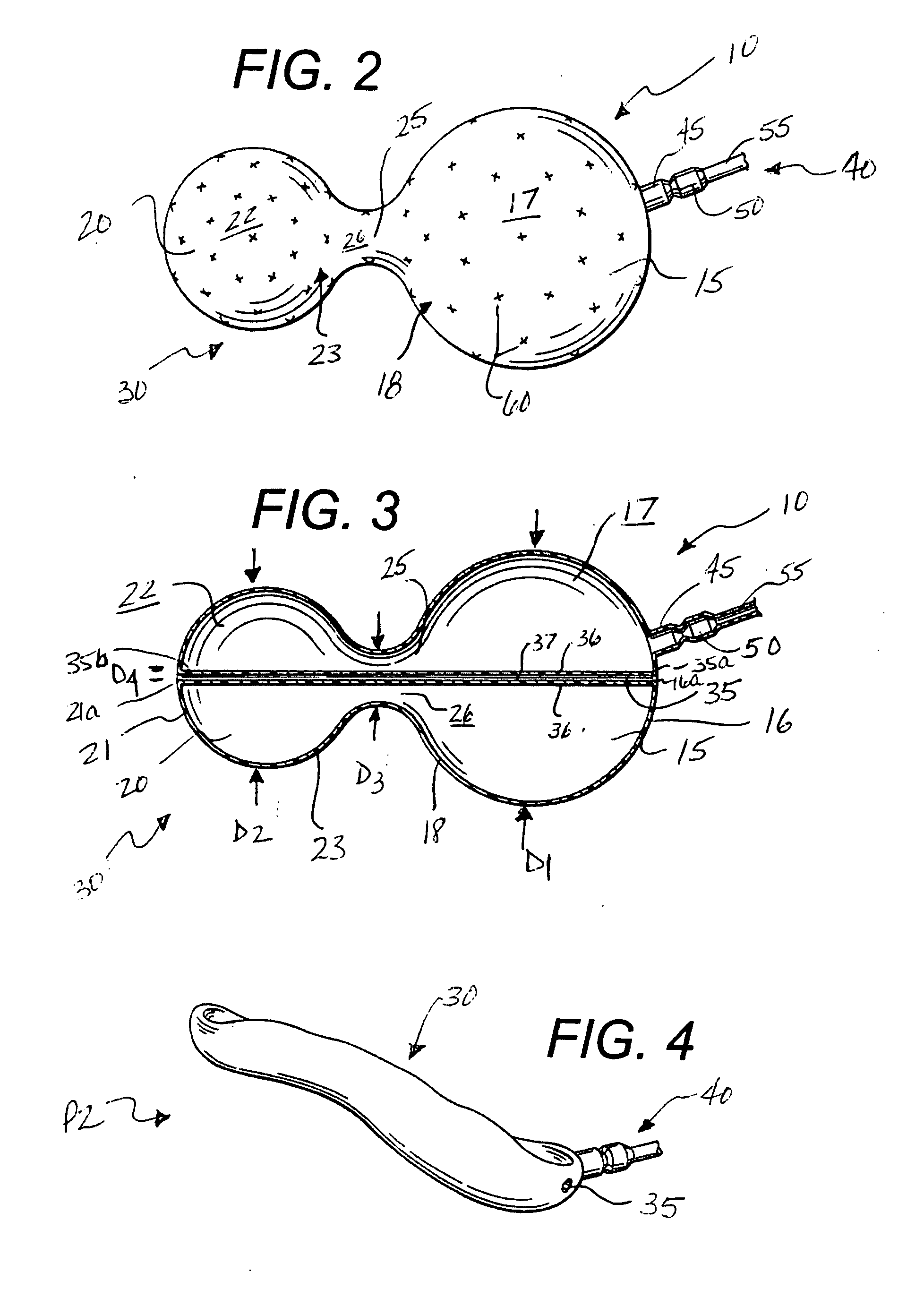 Method for treating obesity using an implantable weight loss device