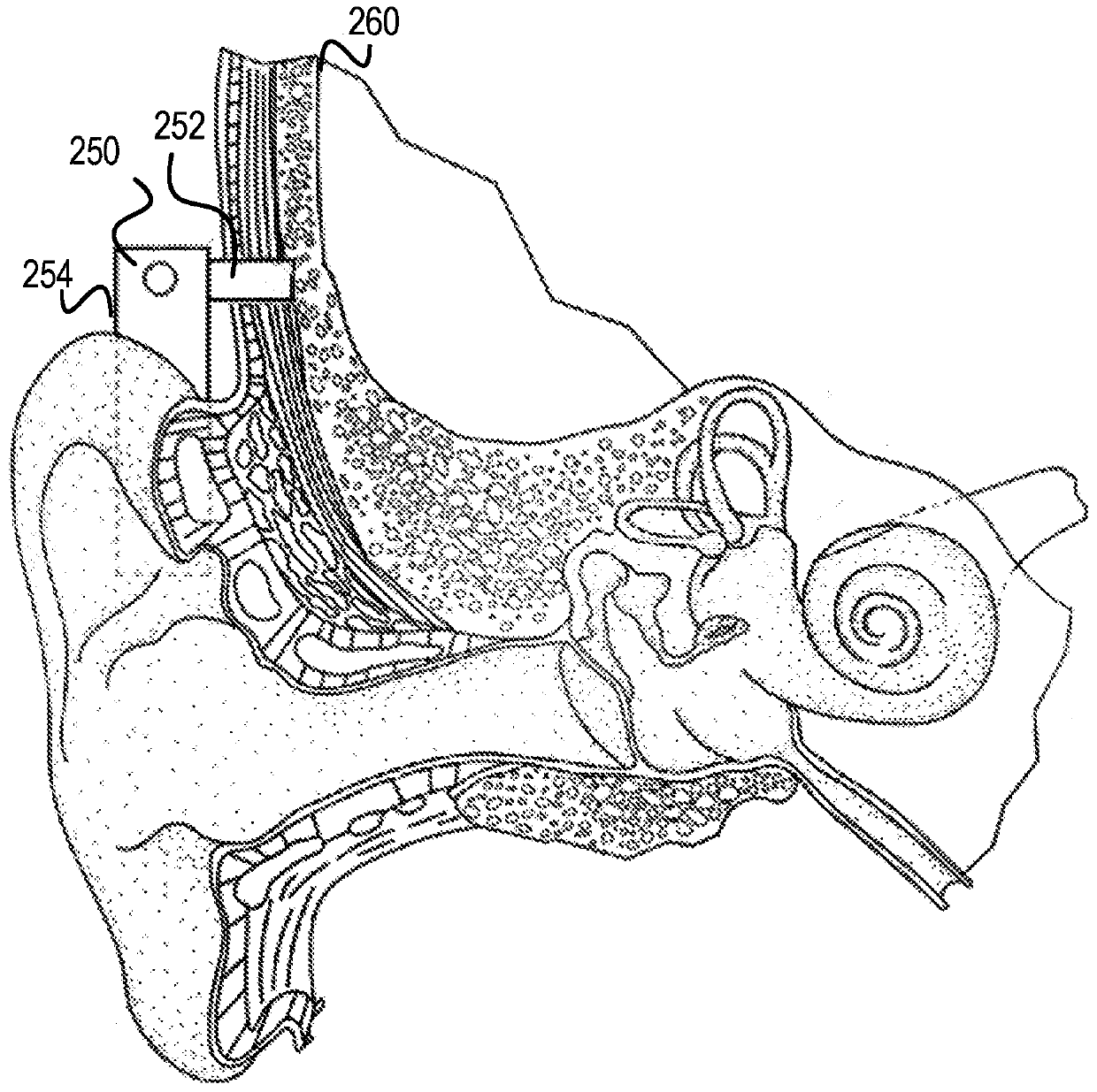 Fits bilateral hearing prosthesis systems