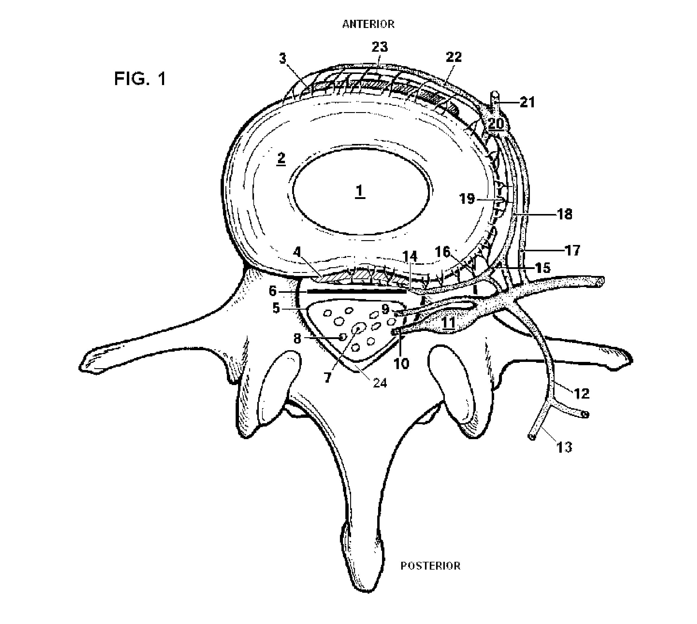 System and Methods for Diagnosis and Treatment of Discogenic Lower Back Pain