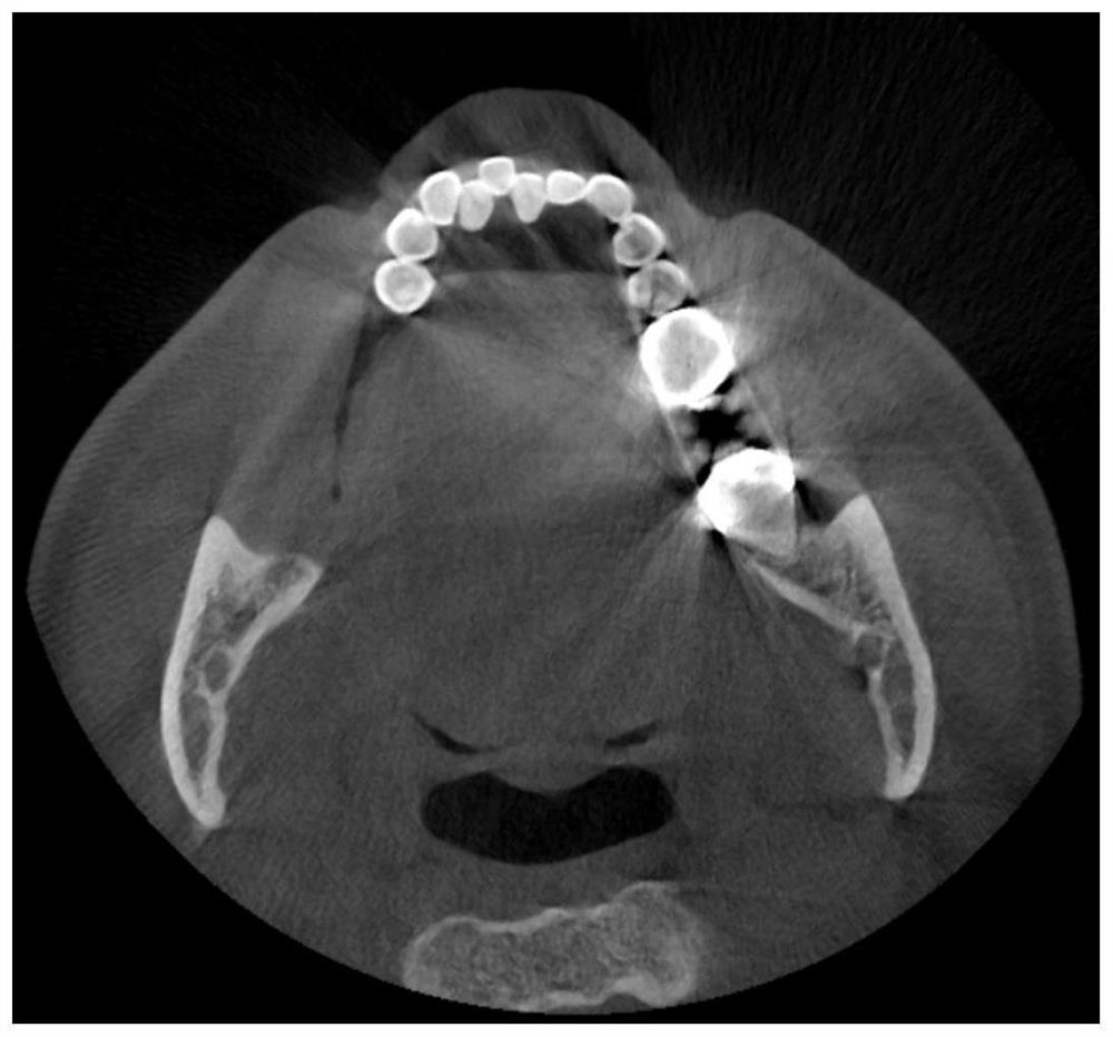 Method and system for removing metal artifacts of oral cavity cone beam CT (Computed Tomography) image