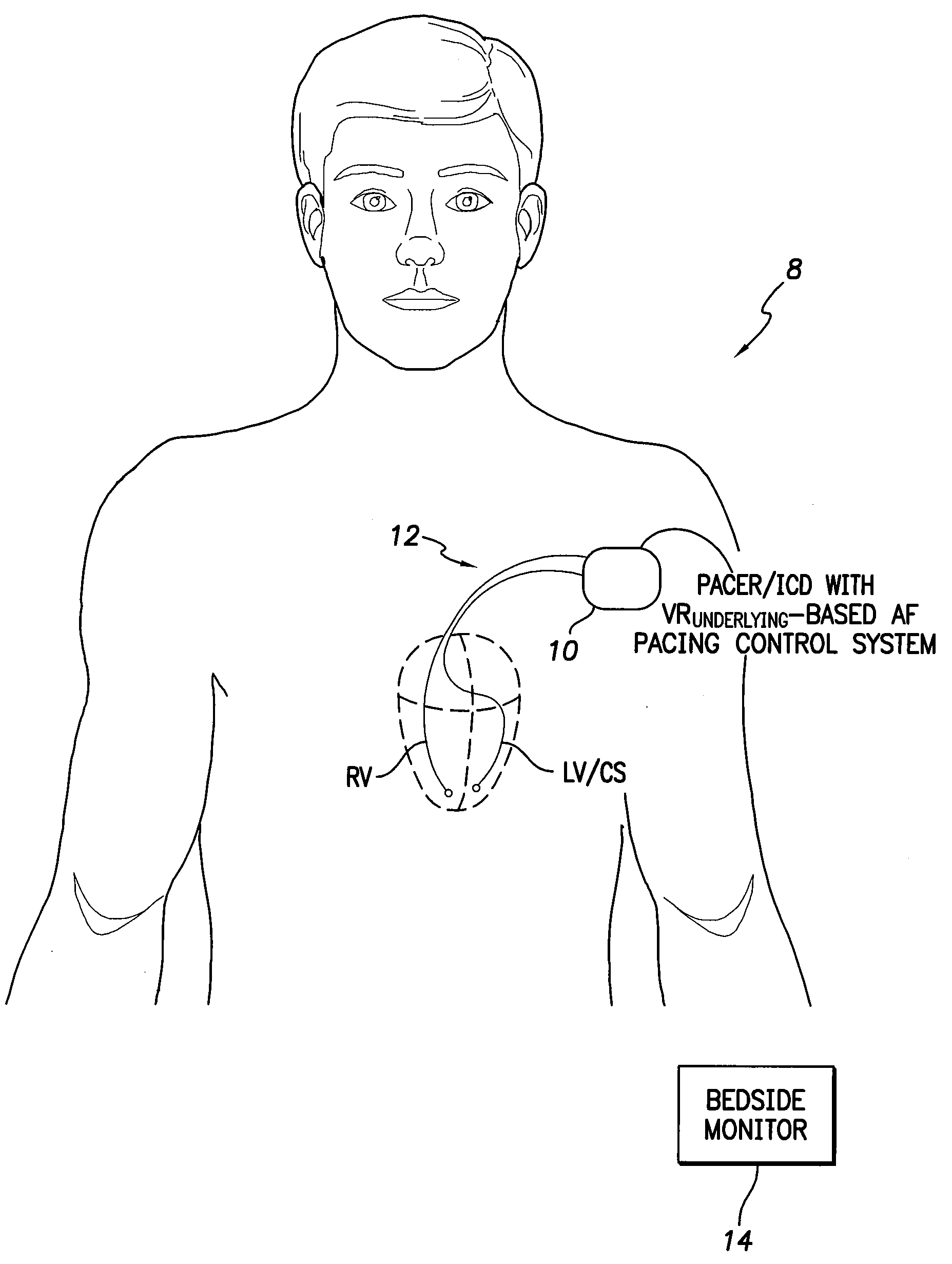 System and Method for Controlling Ventricular Pacing During AF Based on Underlying Ventricular Rates Using an Implantable Medical Device