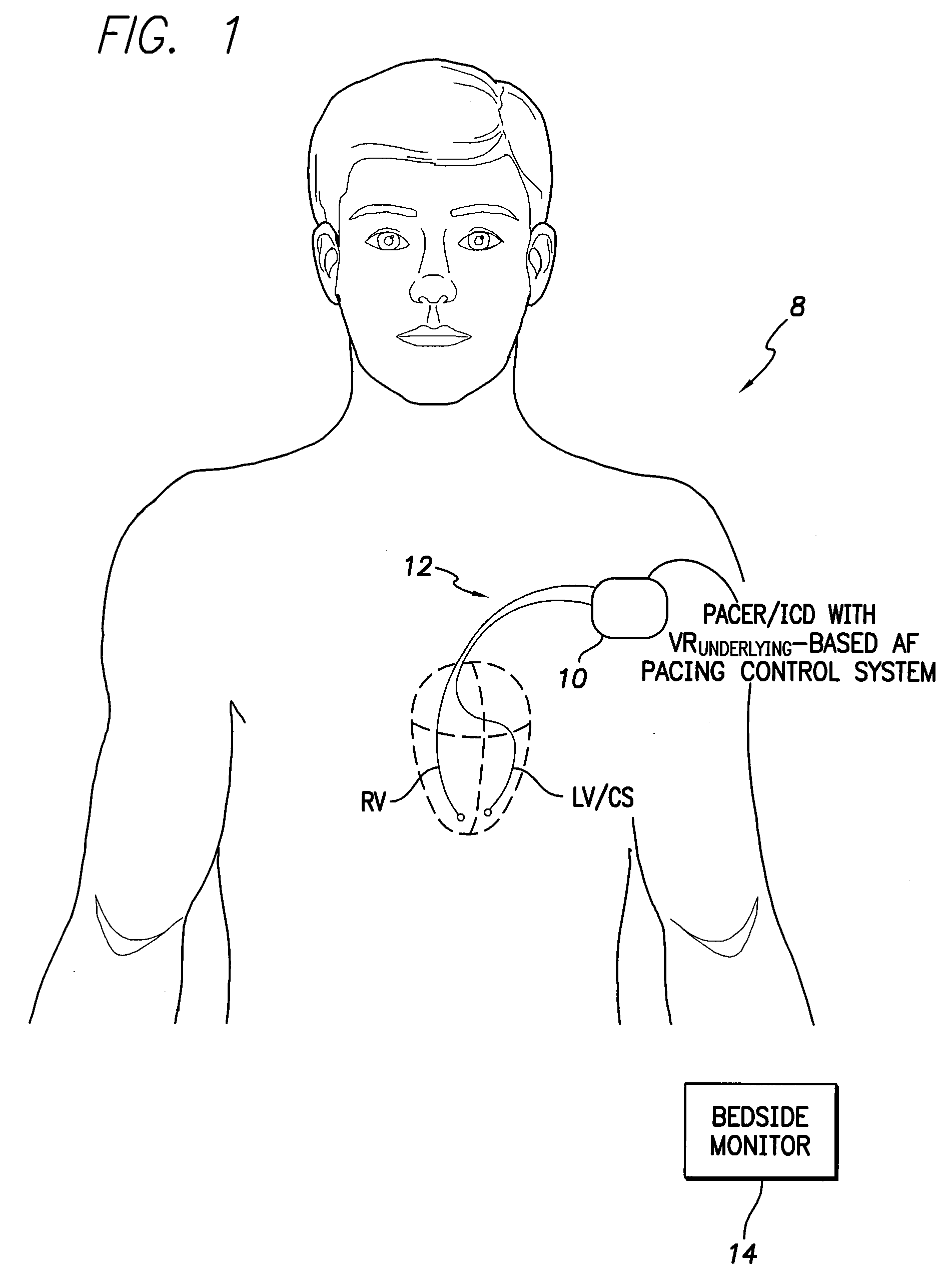 System and Method for Controlling Ventricular Pacing During AF Based on Underlying Ventricular Rates Using an Implantable Medical Device