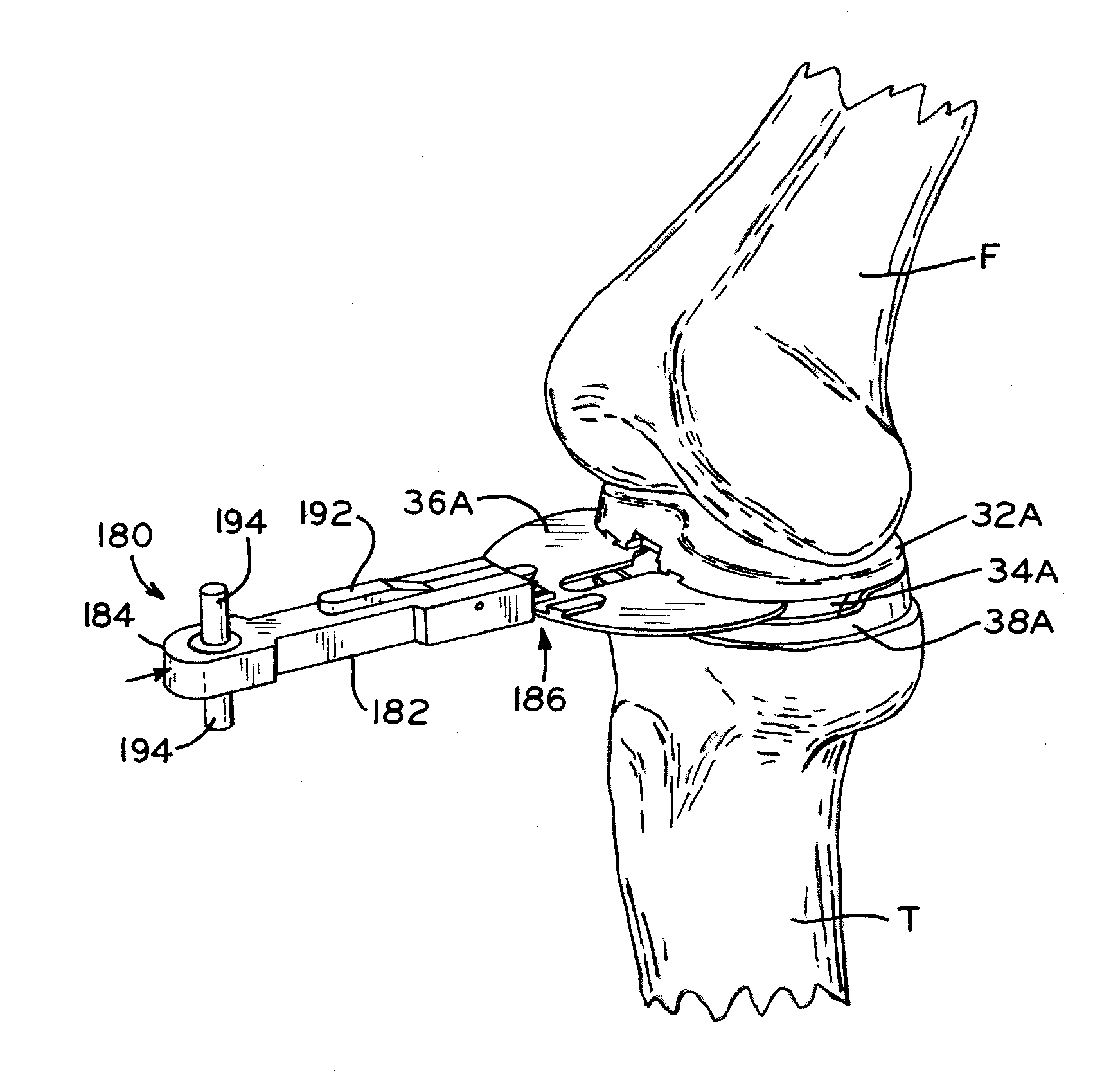 Provisional tibial prosthesis system