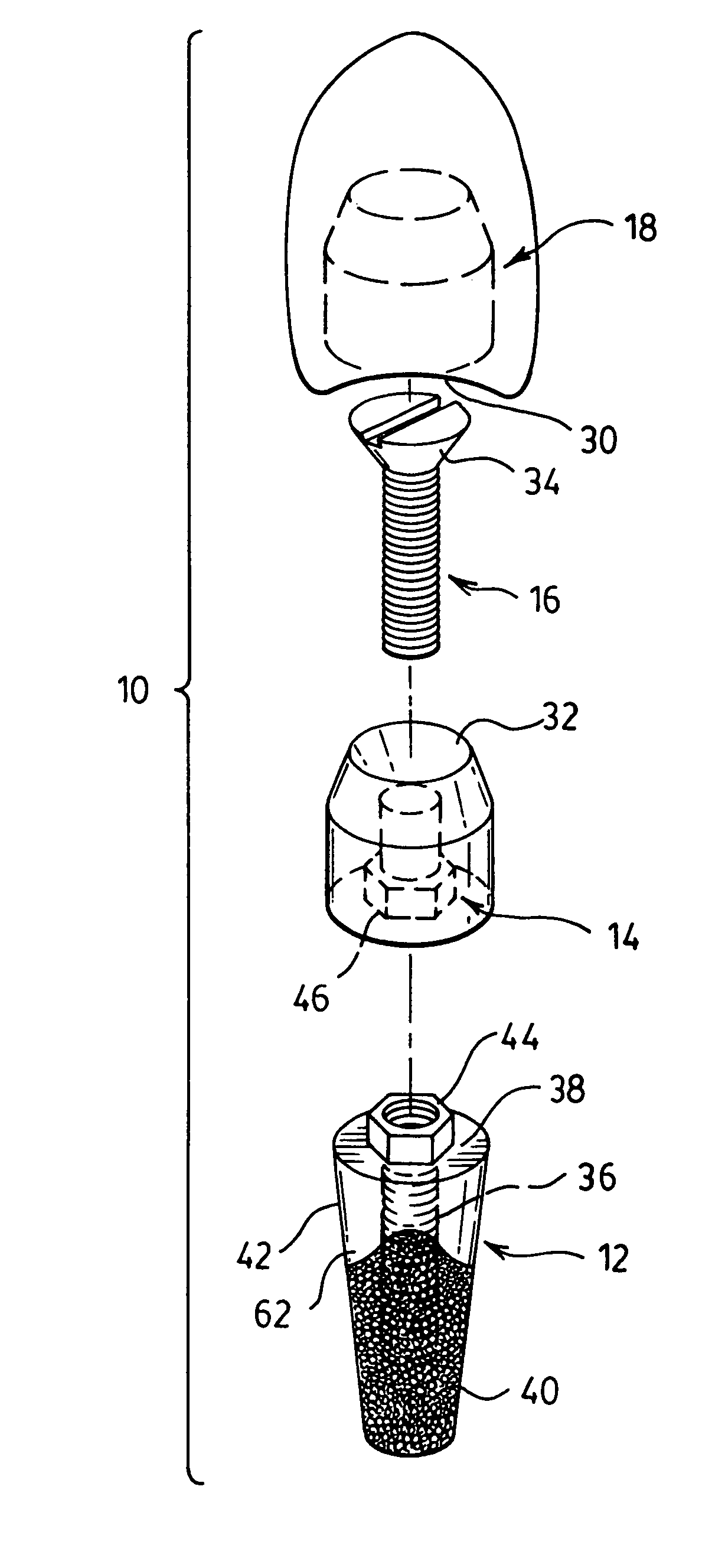 Implant for use in aesthetic regions of the mouth with colored contoured edge portion