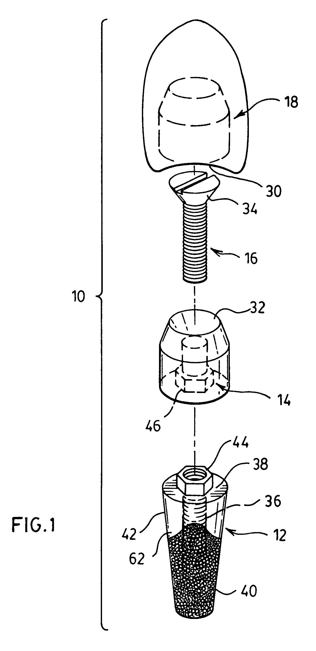 Implant for use in aesthetic regions of the mouth with colored contoured edge portion