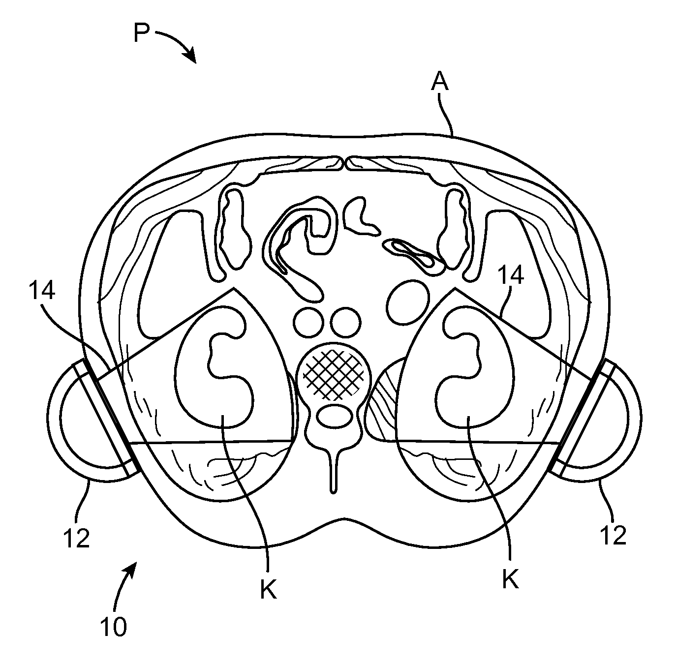 Renal Injury Inhibiting Devices, Systems, and Methods Employing Low-Frequency Ultrasound or Other Cyclical Pressure Energies