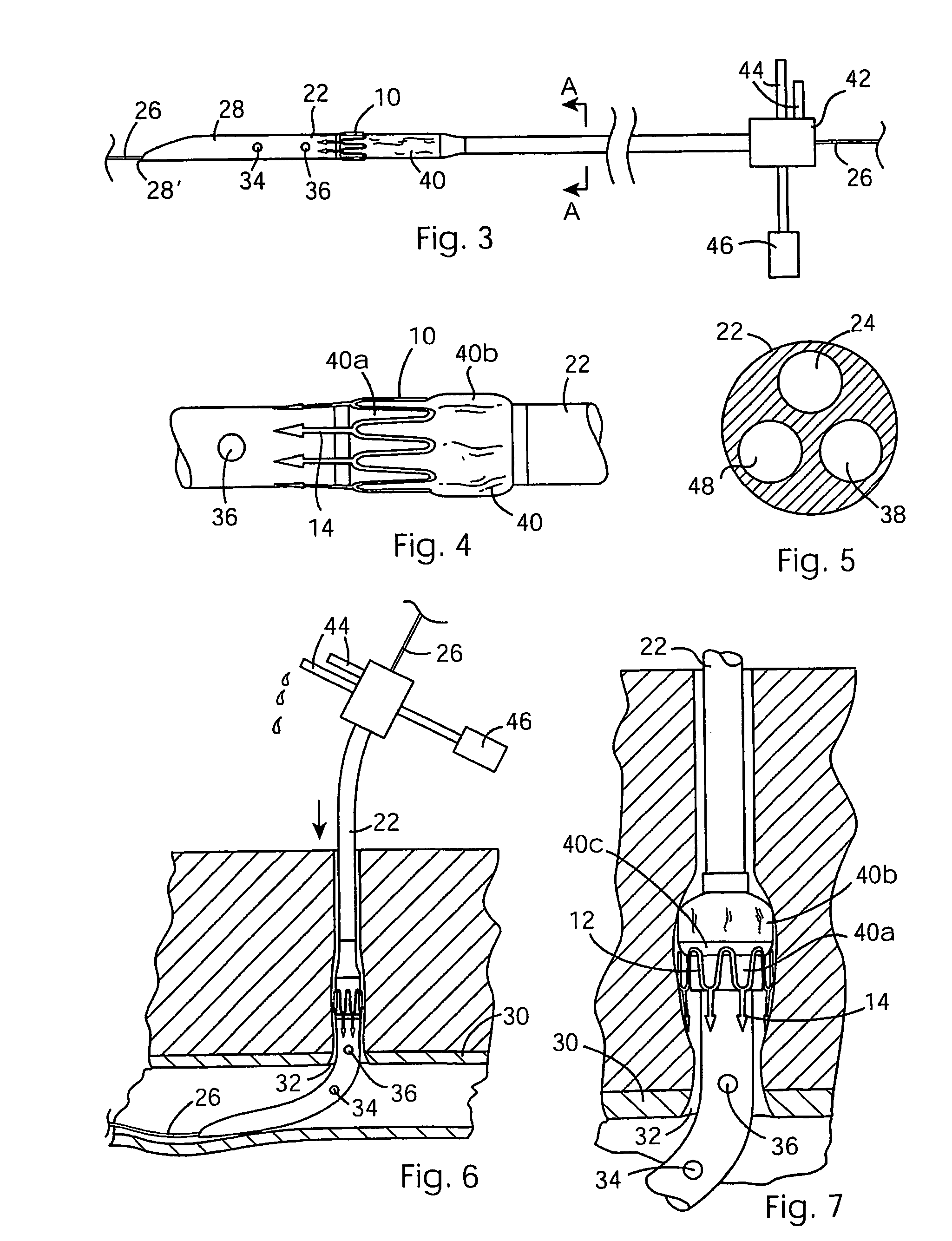 Blood vessel closure clip and delivery device