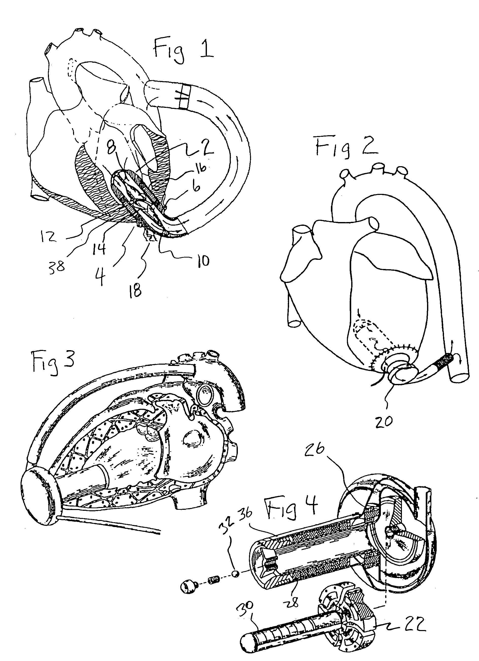 Textured conforming shell for stabilization of the interface of precision heart assist device components to tissues