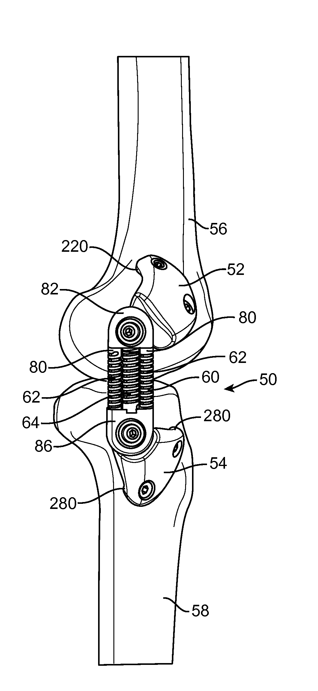 Implantation Approach and Instrumentality for an Energy Absorbing System