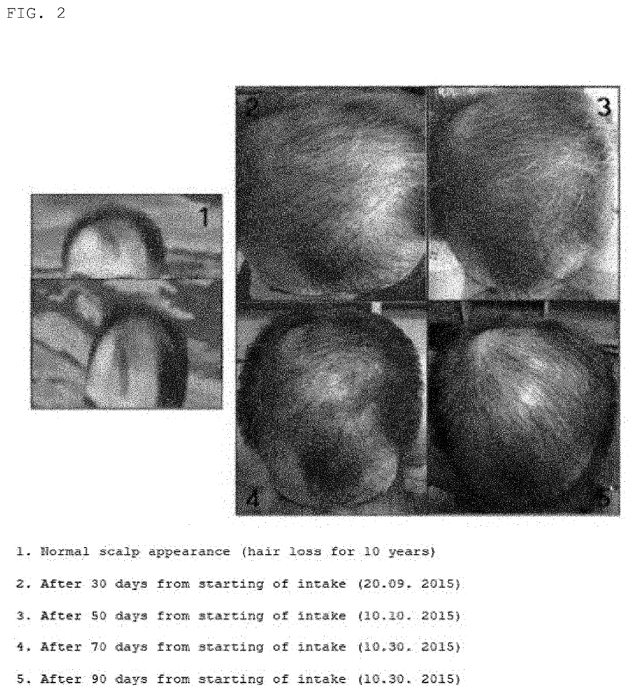 Edible cricket composition for preventing hair loss, improving hair follicle, and promoting hair regrowth