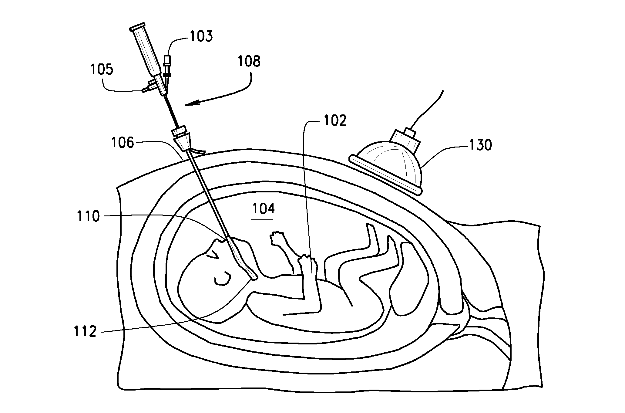 Method and apparatus for delivery into the fetal trachea