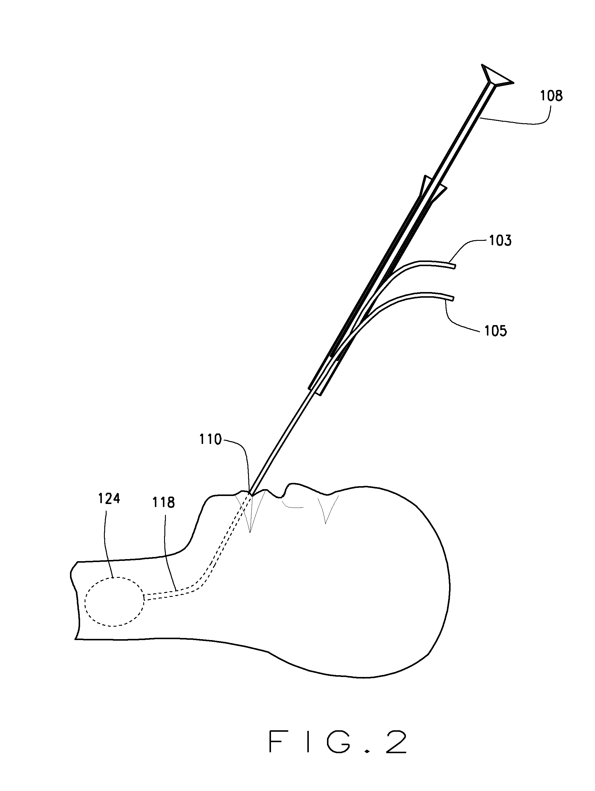 Method and apparatus for delivery into the fetal trachea