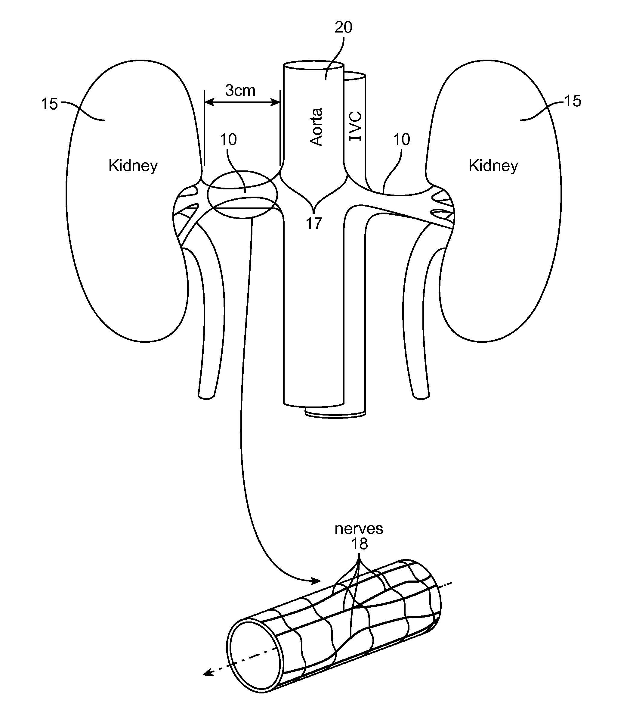 Method and apparatus employing ultrasound energy to remodulate vascular nerves